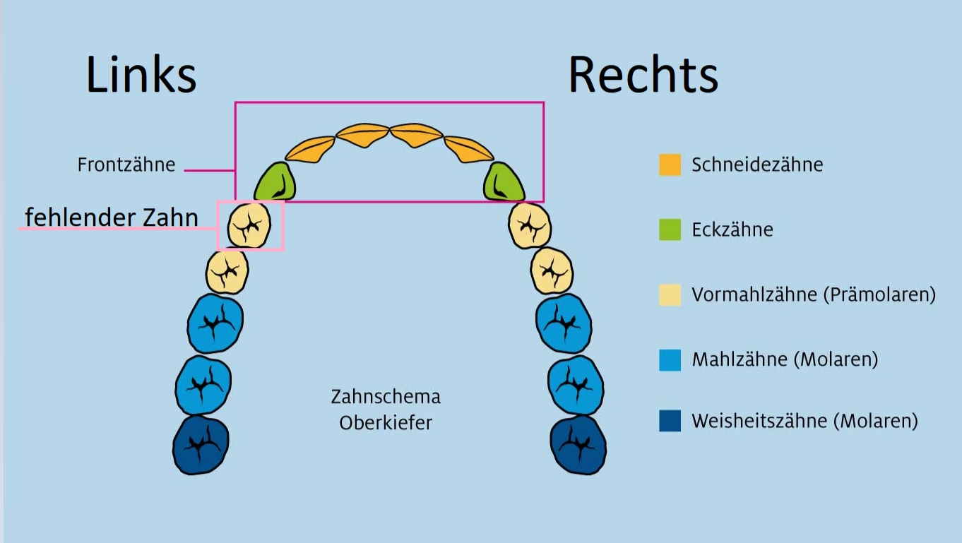 Spende für einen Einzelzahnimplantat mit Knochenaufbau photo