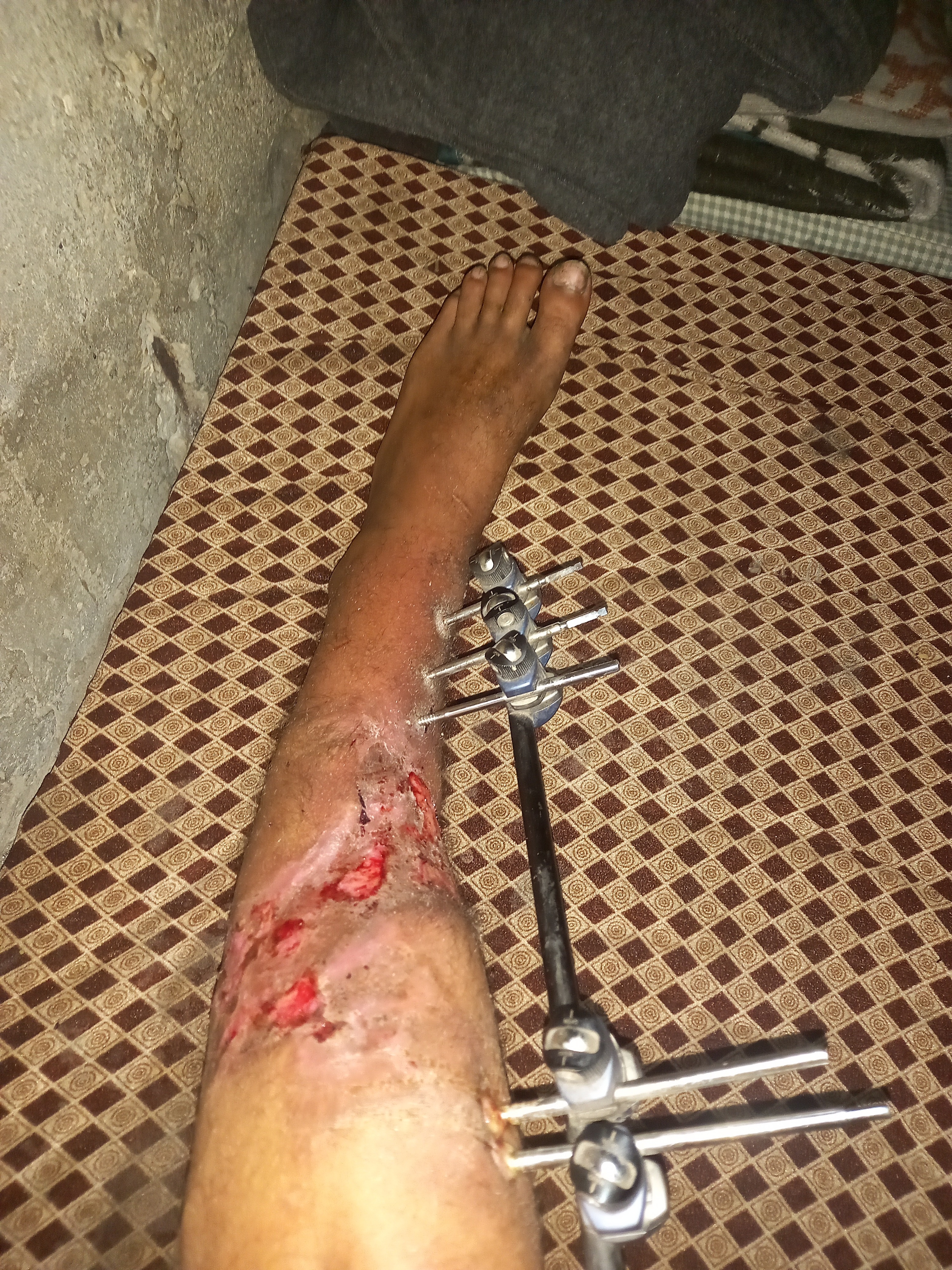 I need bone grafting surgery on both feet; I was completely campaign photo, 2 of 4