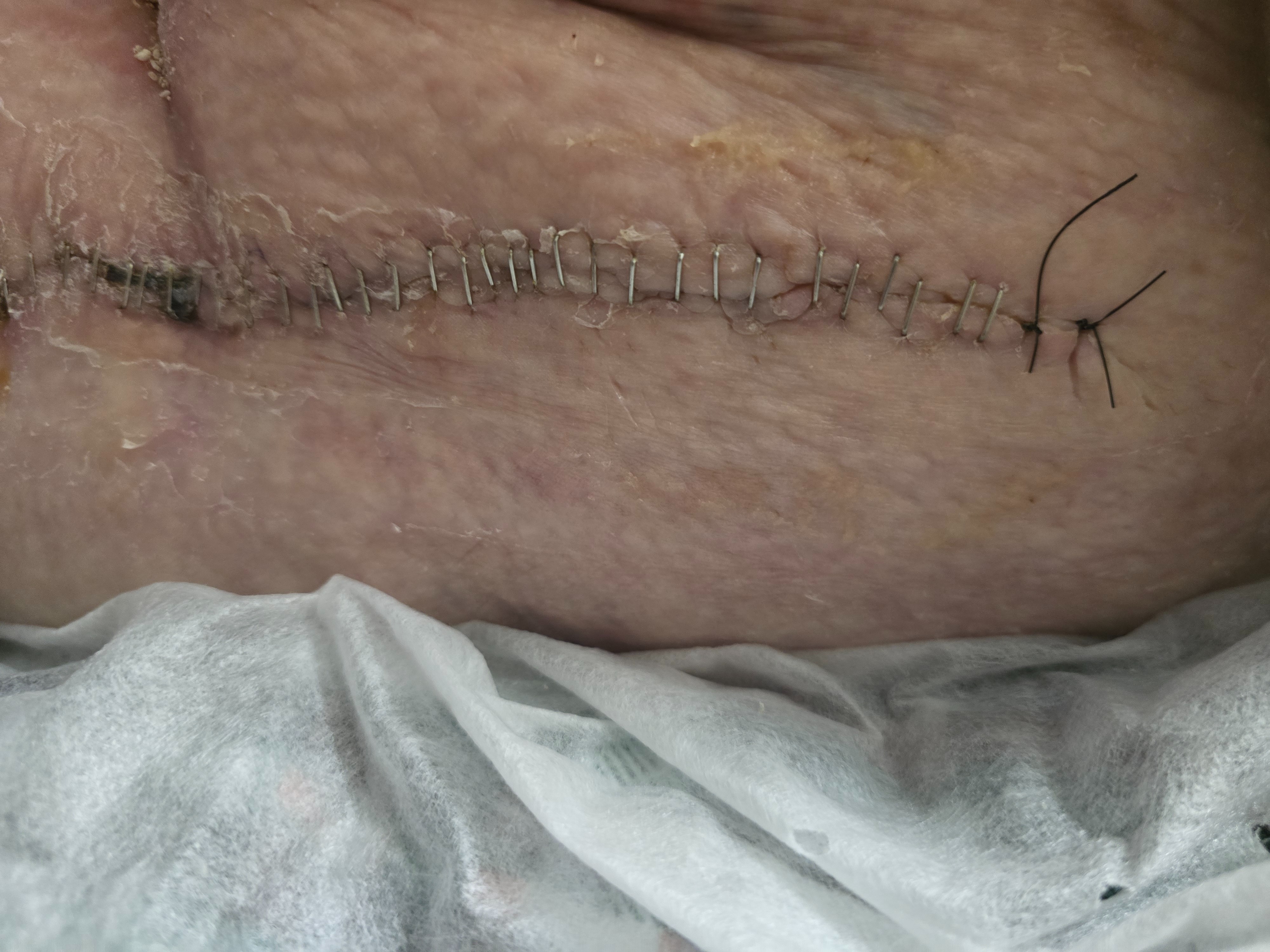 Help Beth Recover After Hip Surgery campaign photo, 2 of 7