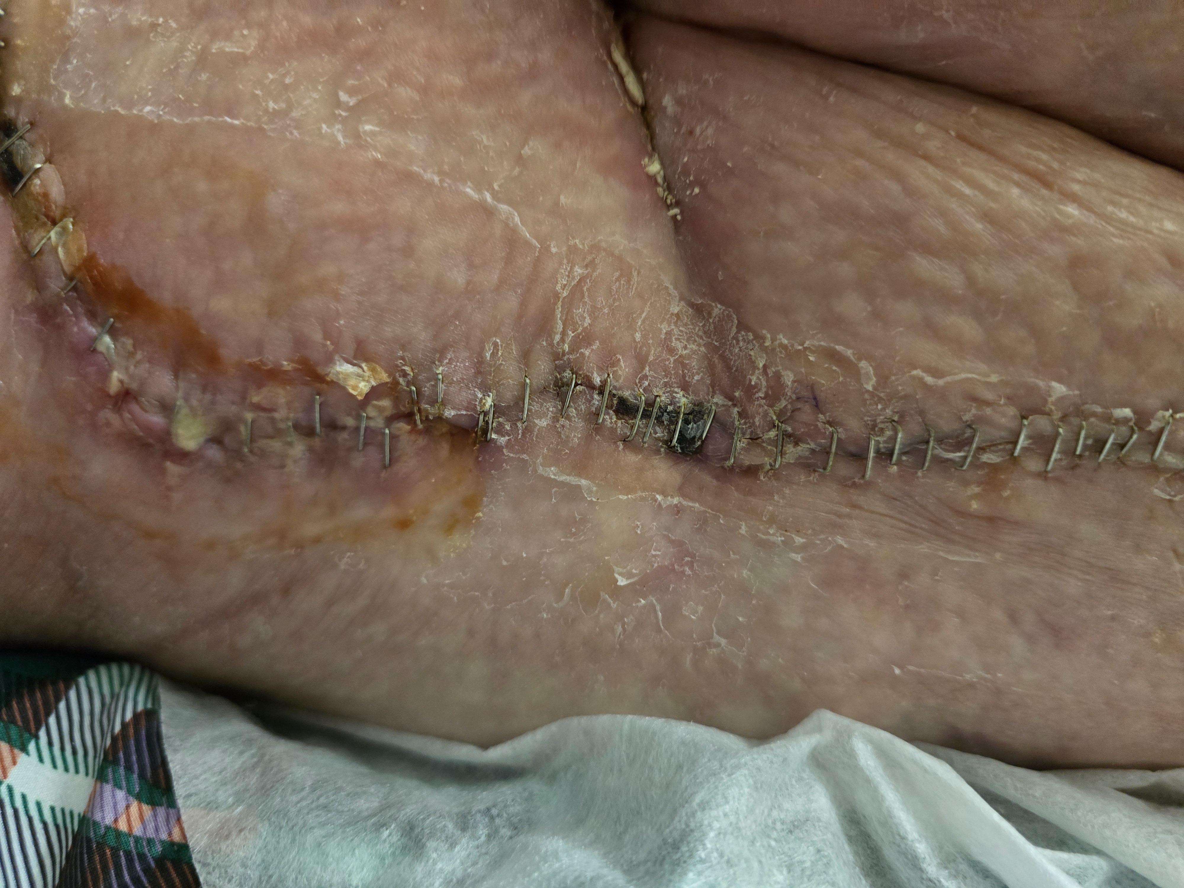 Help Beth Recover After Hip Surgery campaign photo, 4 of 7