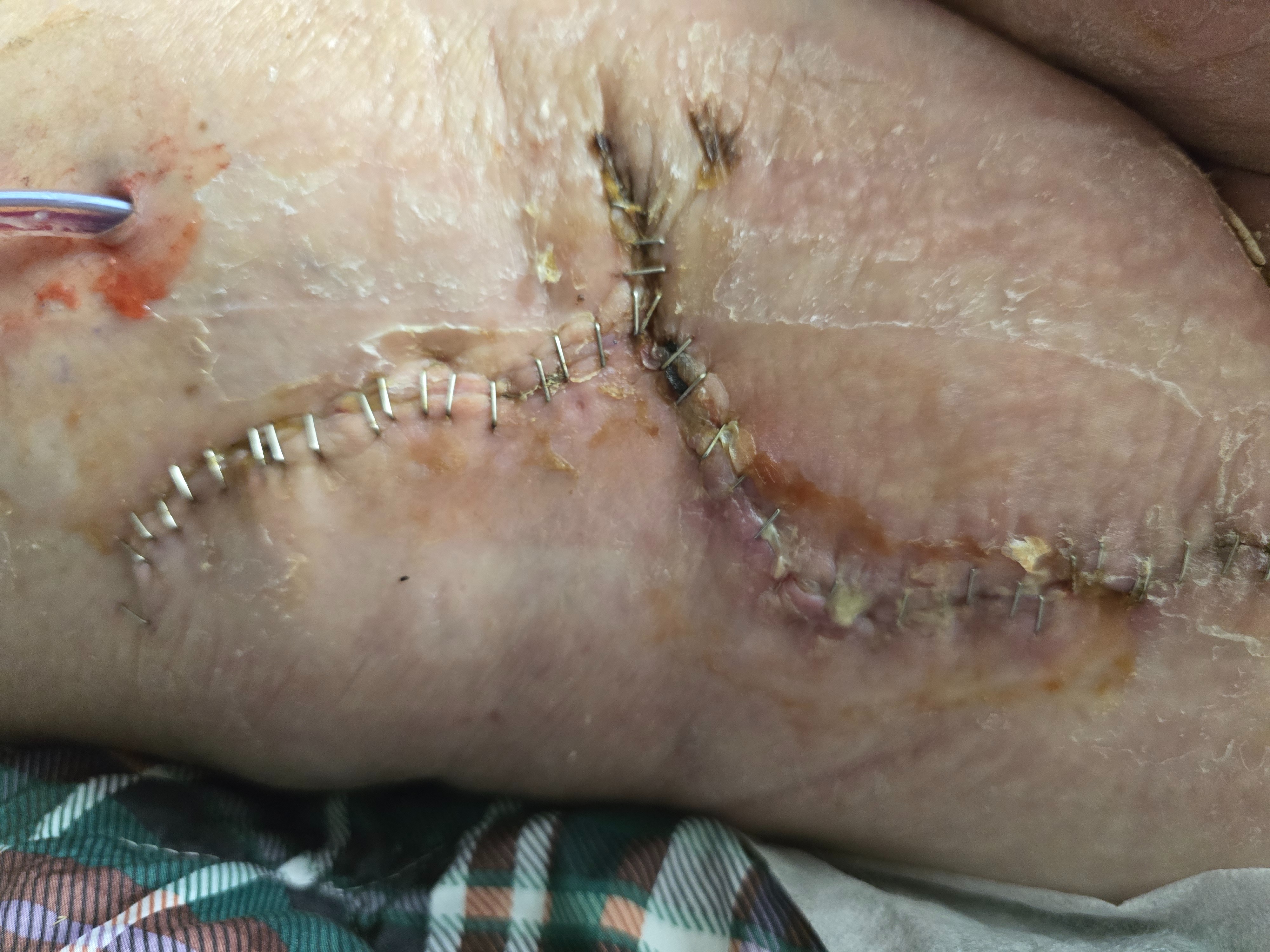 Help Beth Recover After Hip Surgery campaign photo, 5 of 7