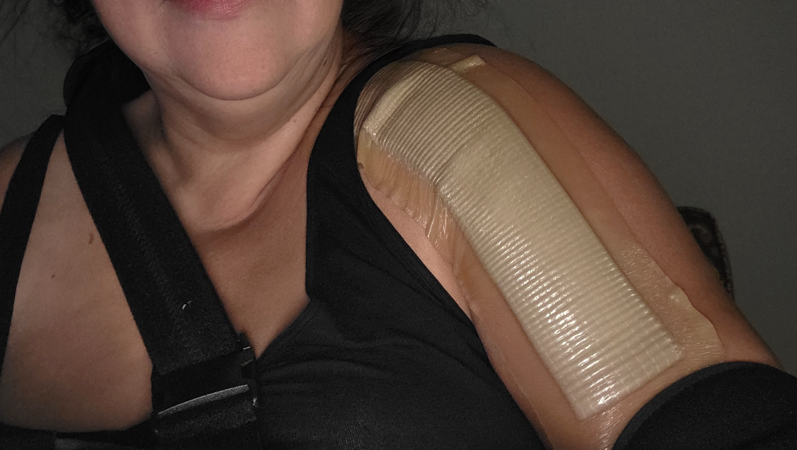 Help With Living Expenses After Shoulder Surgery