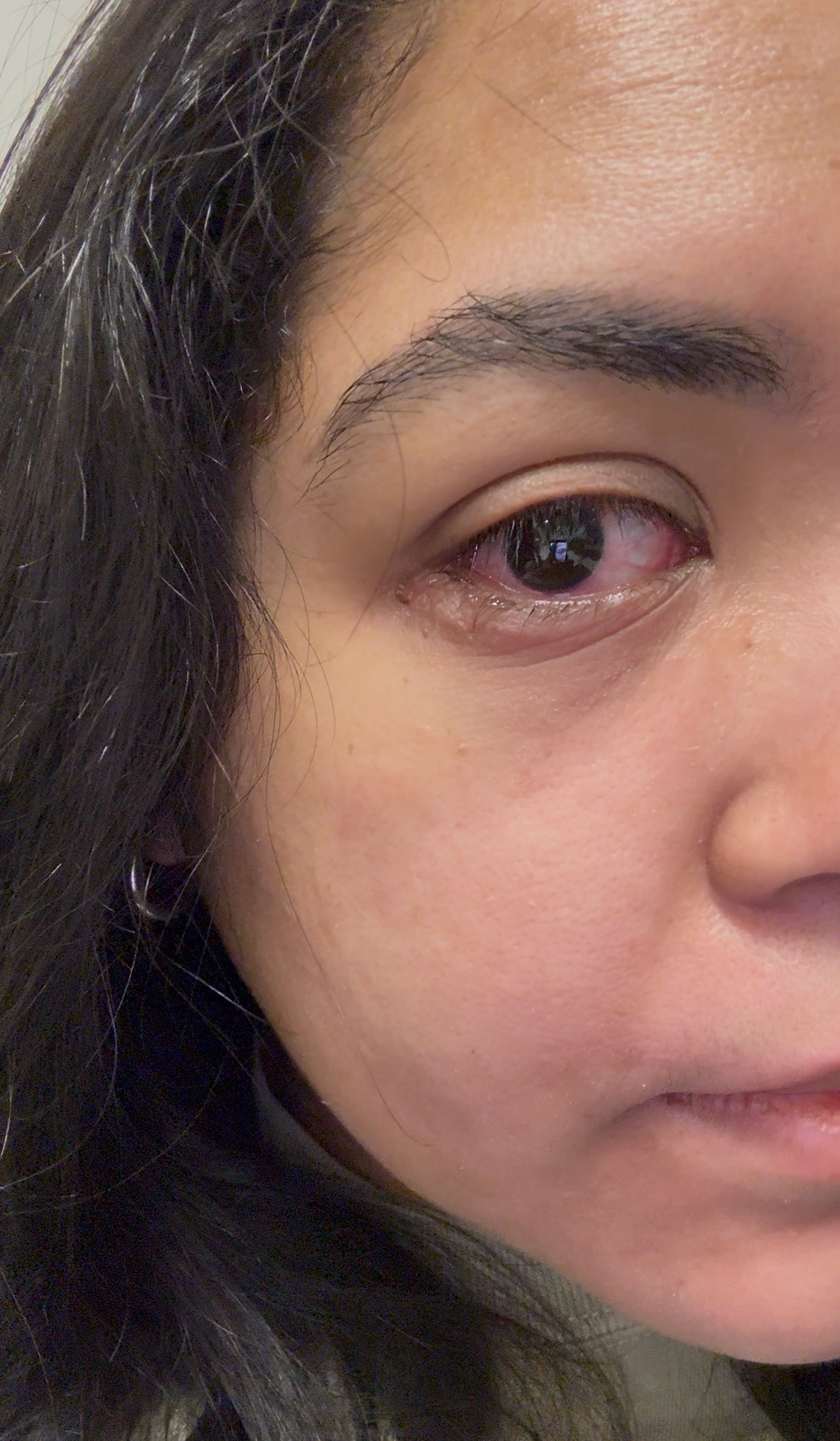Help Sherri Fight Peri Orbital Cellulitis campaign photo, 5 of 7