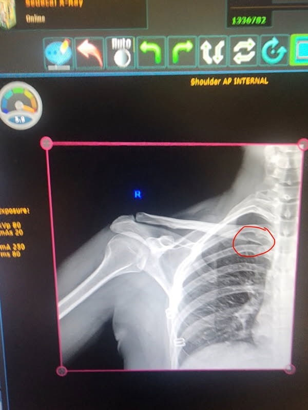 Support My Recovery After Hit-and-Run Accident campaign photo, 2 of 4