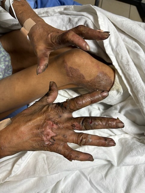 Help Beryl After a Devastating House Fire campaign photo, 2 of 7