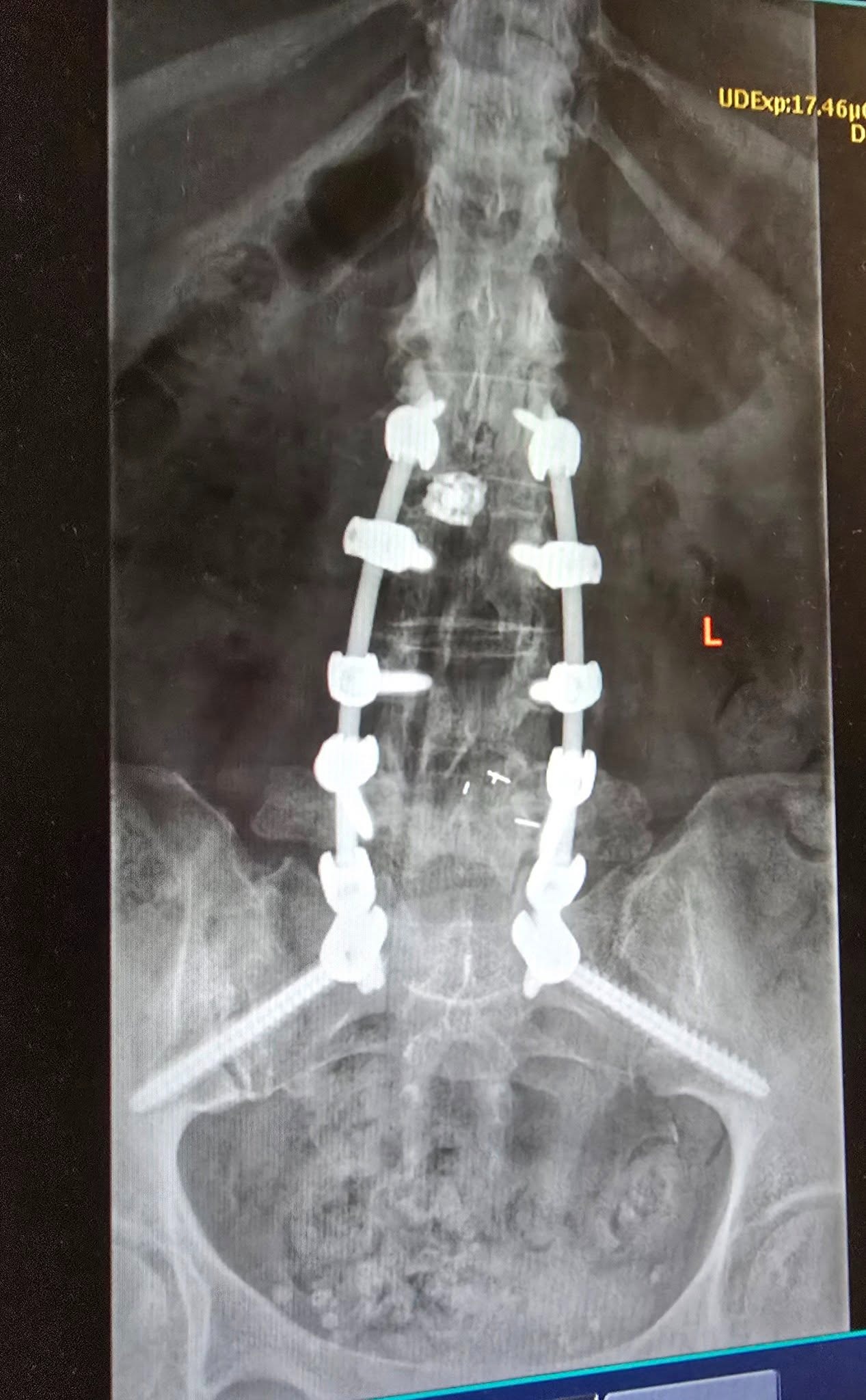 Support for Madison West During Multiple Spine Surgeries campaign photo, 4 of 5