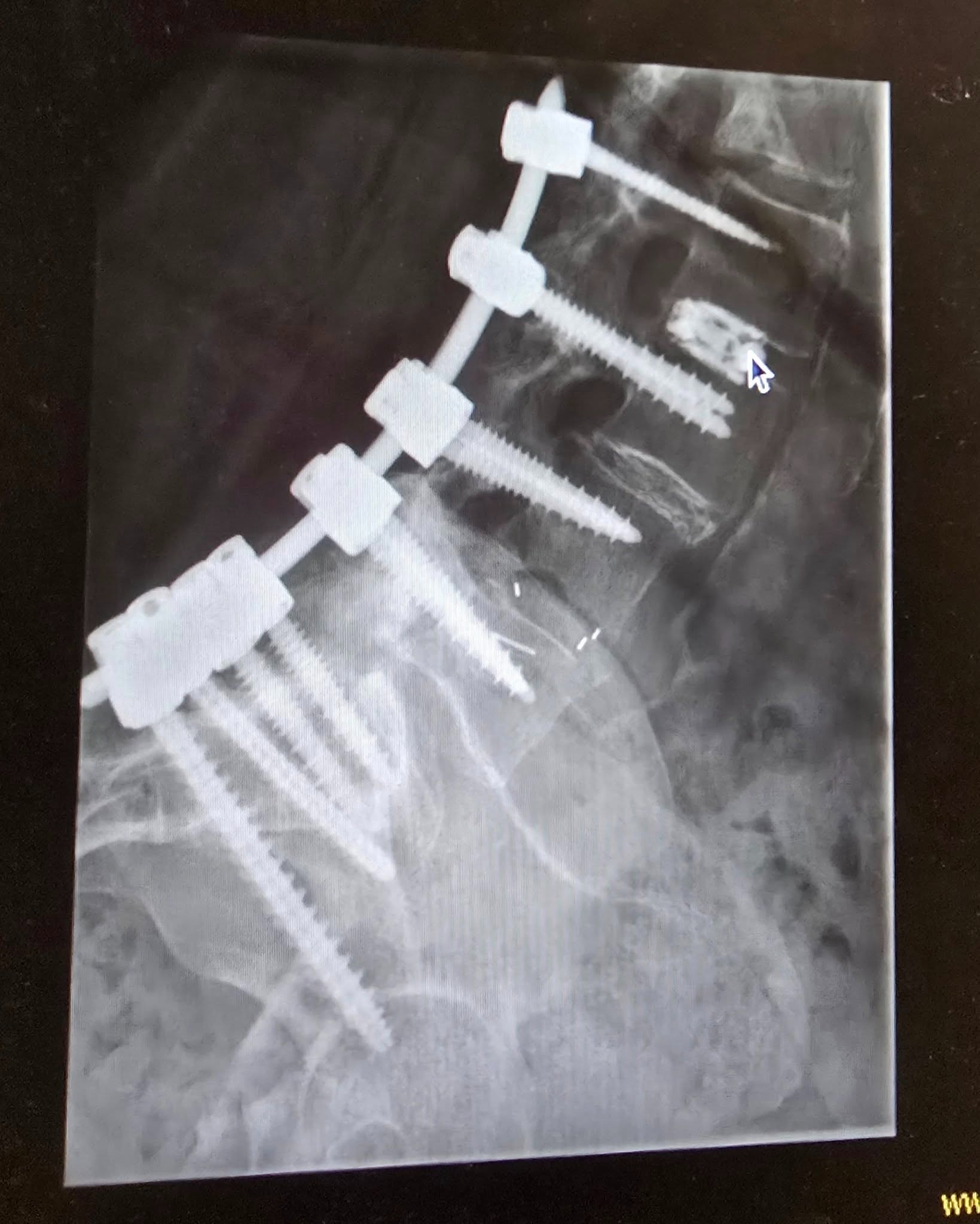 Support for Madison West During Multiple Spine Surgeries campaign photo, 2 of 5
