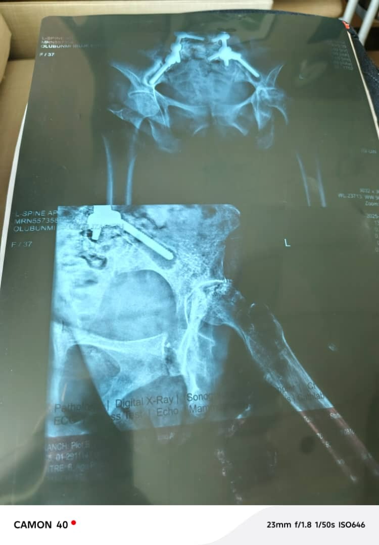 Urgent Help Needed for Life-Saving Spine, Hip, Surgeries campaign photo, 4 of 8