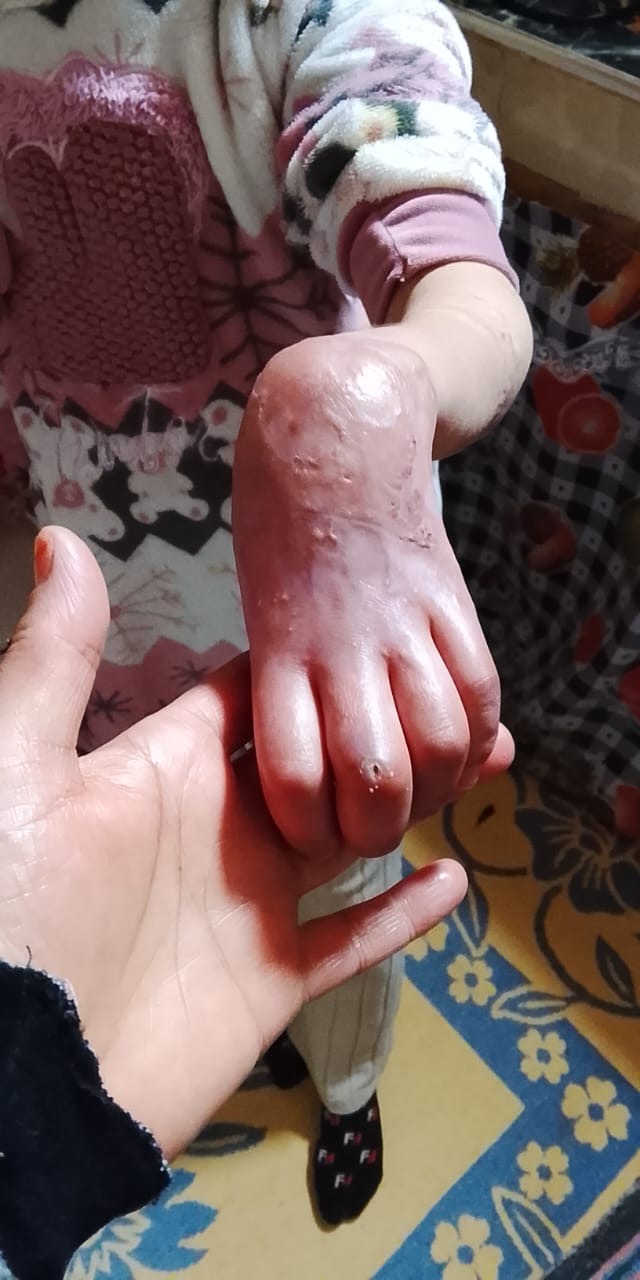 Help 9-Year-Old Hafsa Save the Feeling in Her Hand After Med campaign photo, 6 of 7