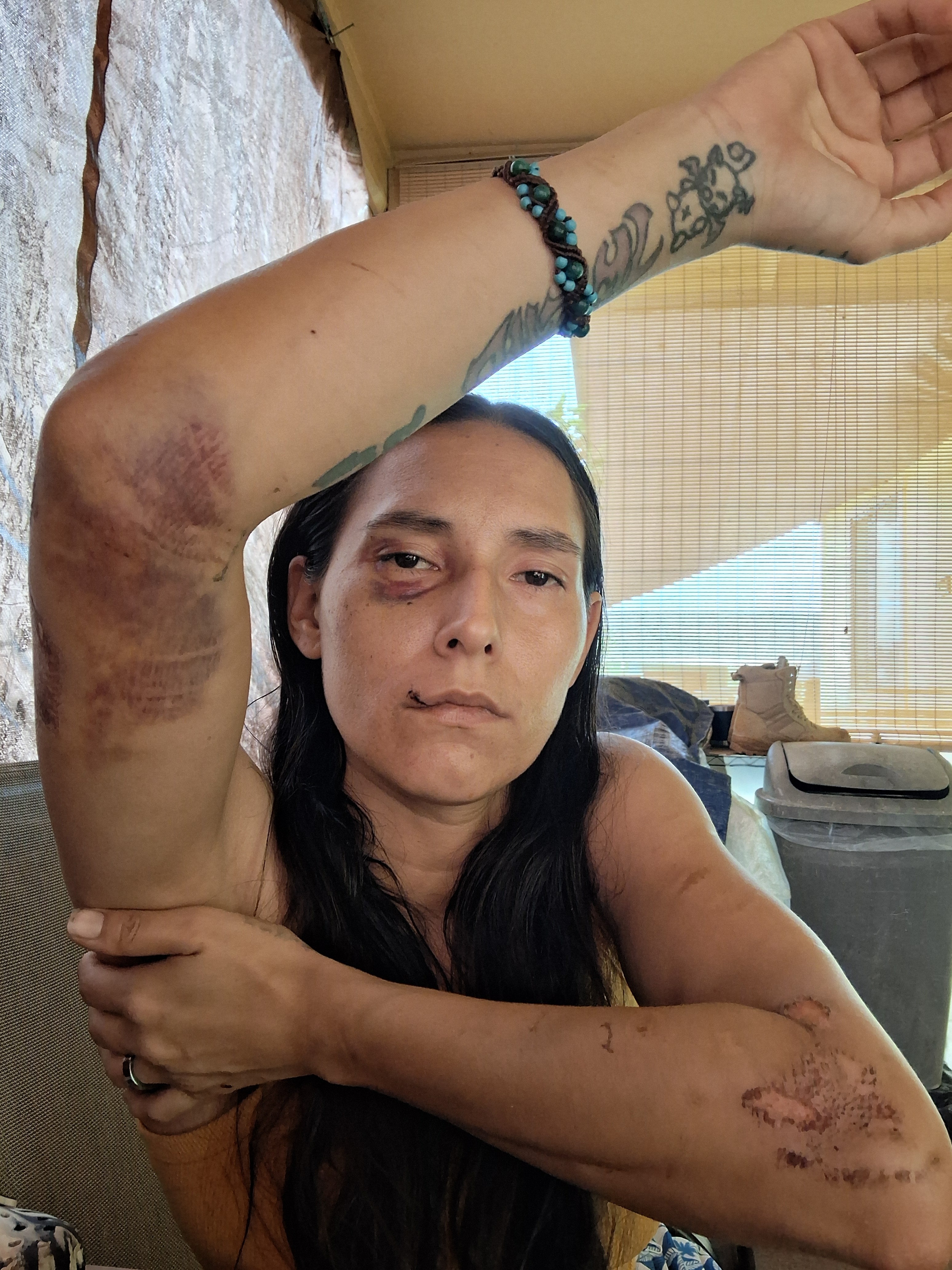 Help Hit and Run survivor Katherine pay ambulance campaign photo, 5 of 8