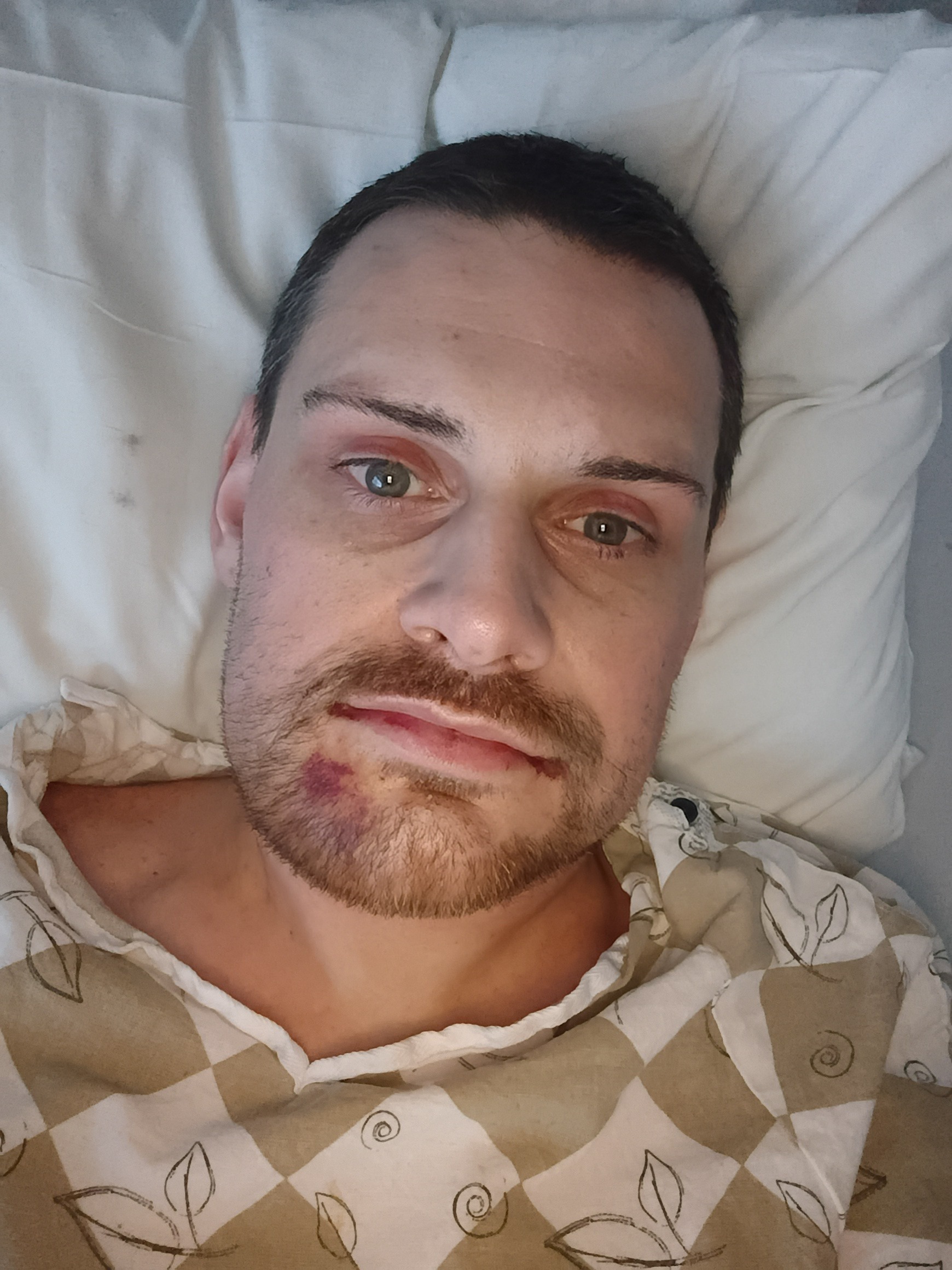 Support My Healing Journey After Jaw Surgery campaign photo, 2 of 7