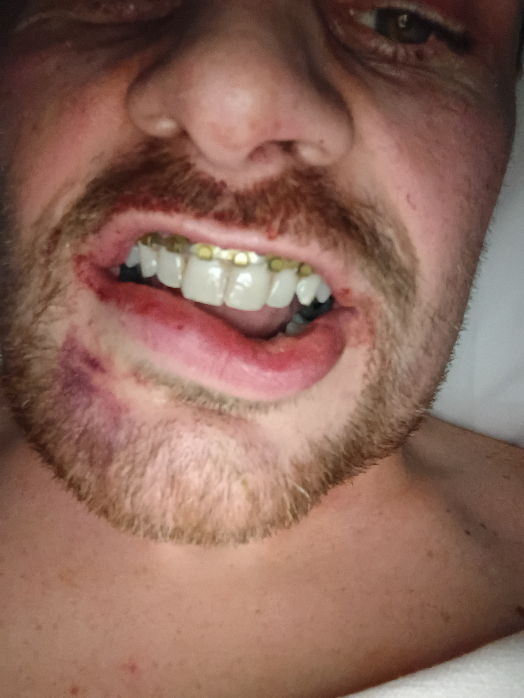 Support My Healing Journey After Jaw Surgery campaign photo, 4 of 7