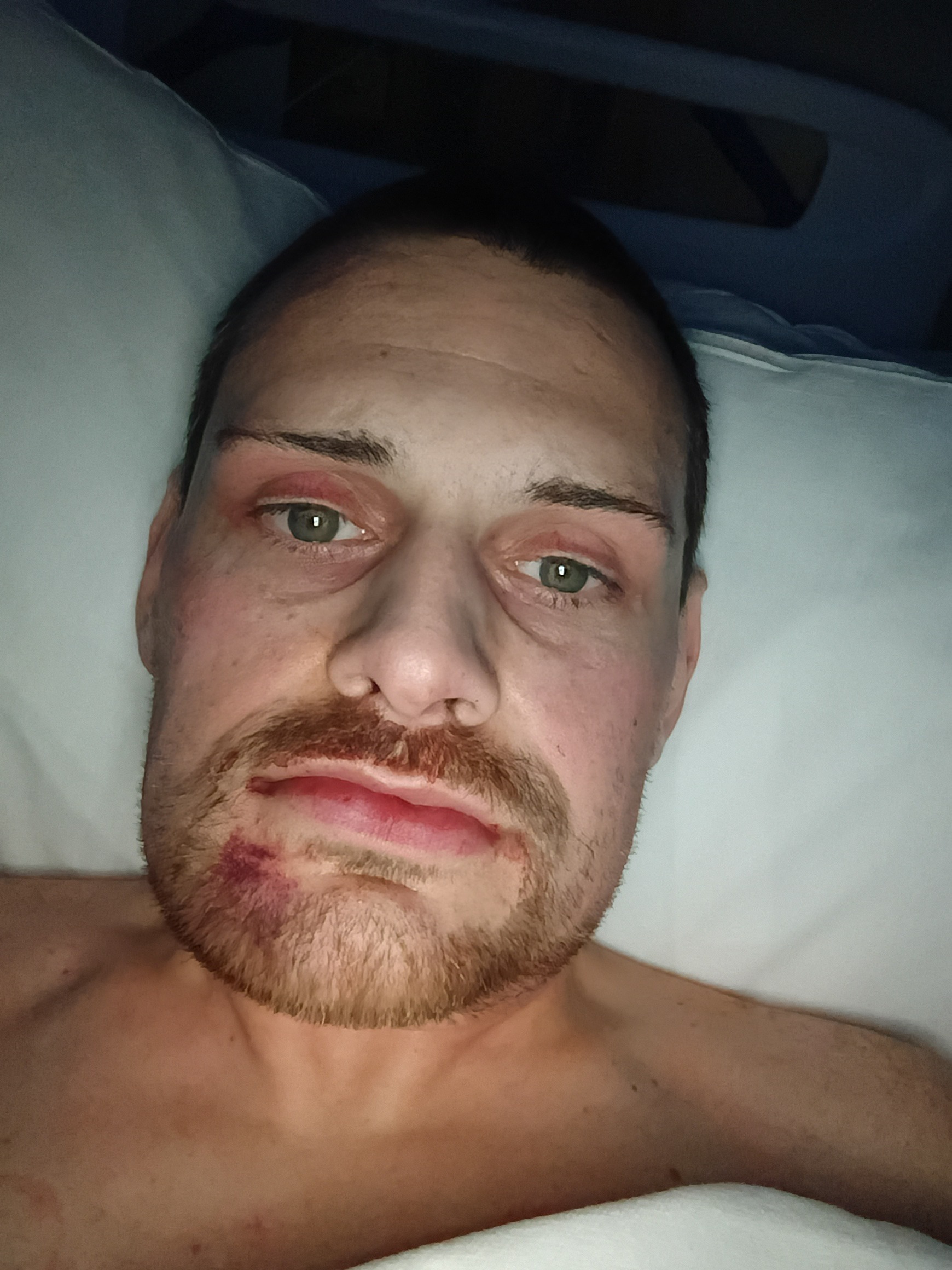 Support My Healing Journey After Jaw Surgery campaign photo, 5 of 7