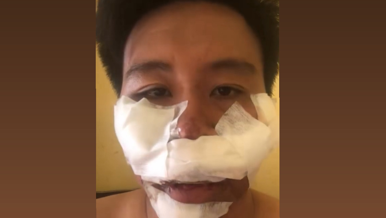 Eka’s bike accident photo