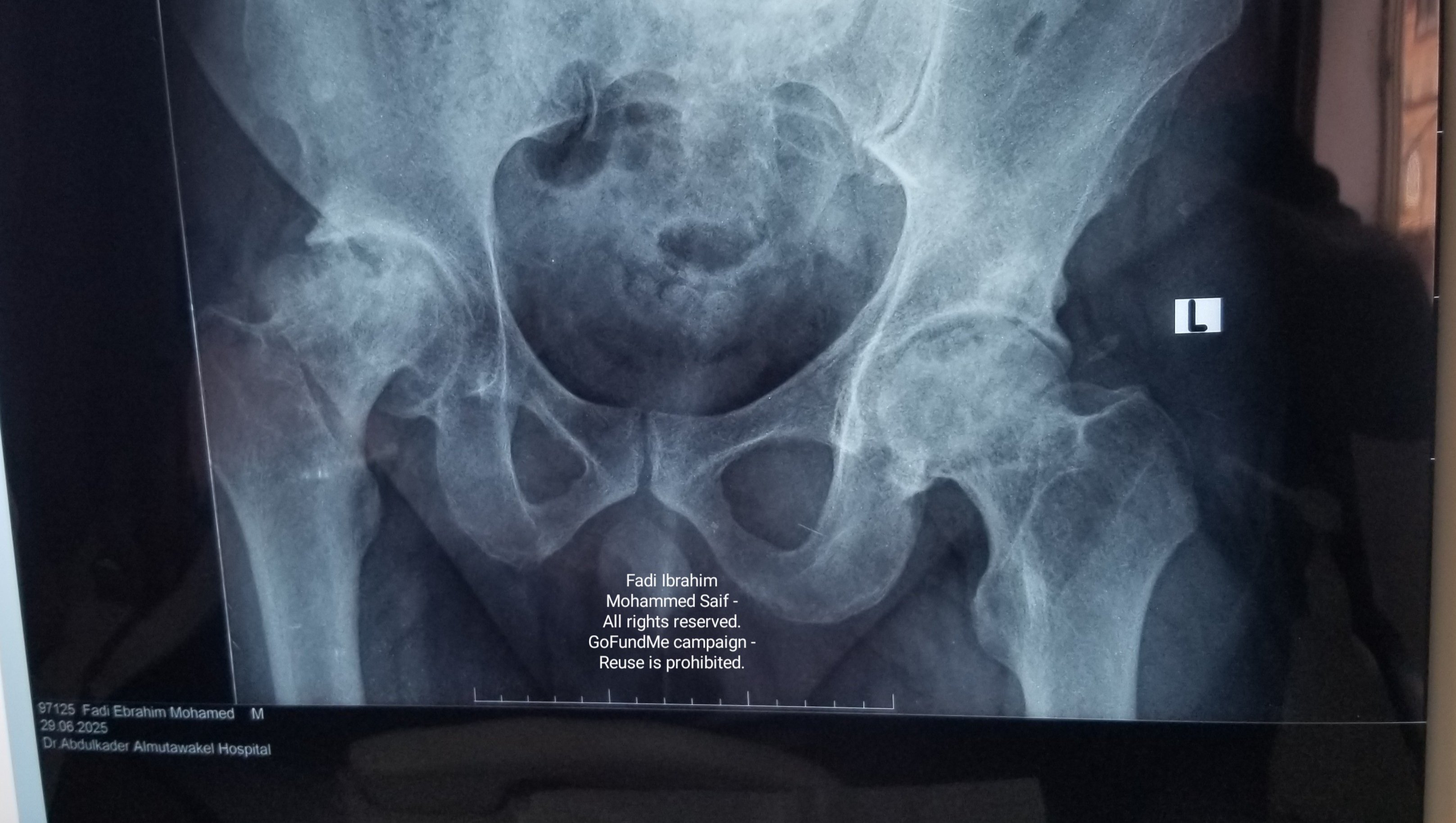 Help Me Walk Without Pain — Urgent Hip Surgery Needed photo