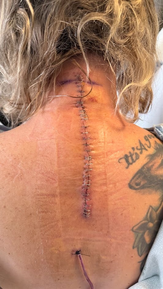 Support Pam’s Recovery from Major Spine Surgery campaign photo, 5 of 7
