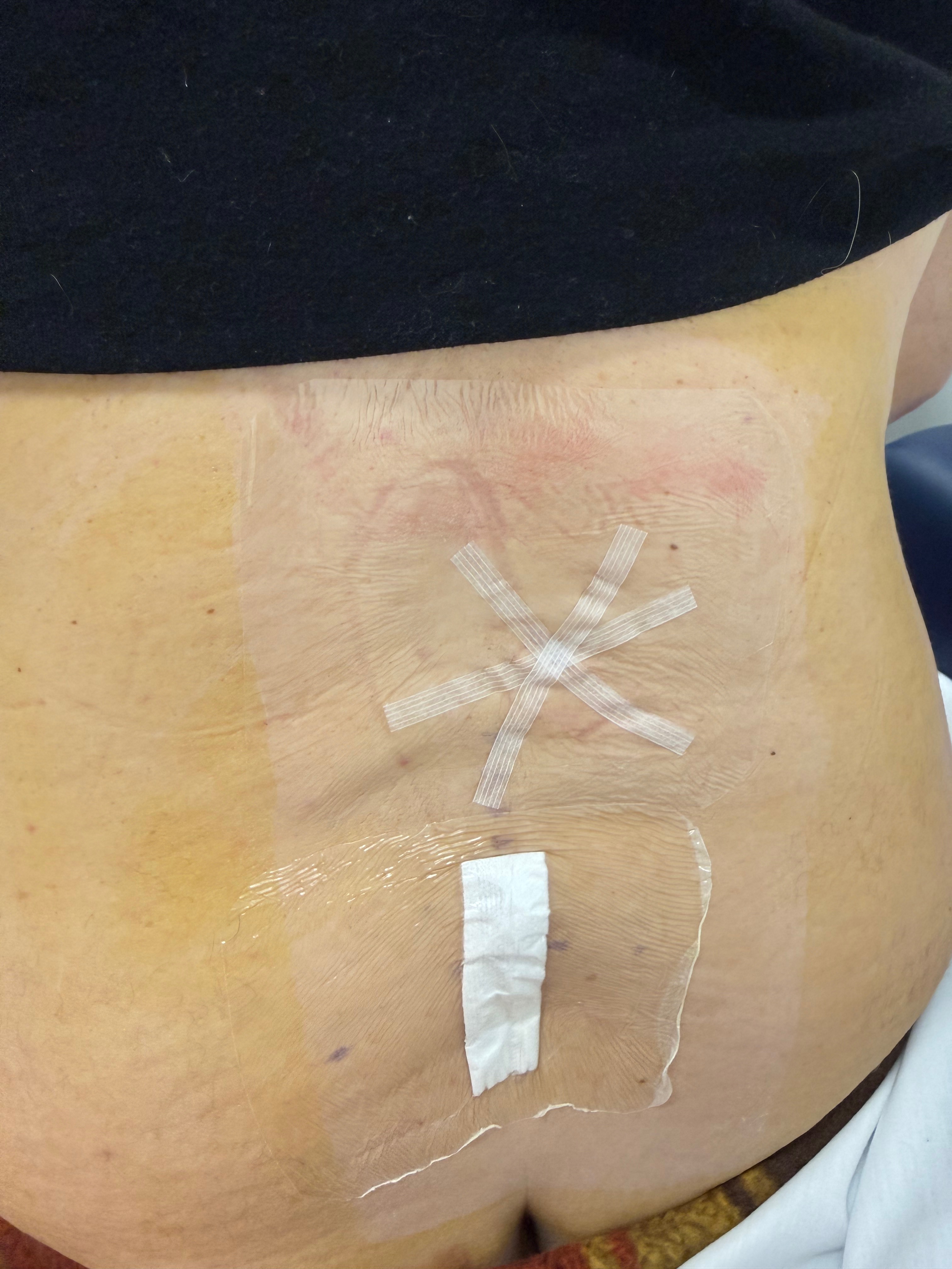 Support My Healing Journey After Back Surgery on January 7th campaign photo, 5 of 6