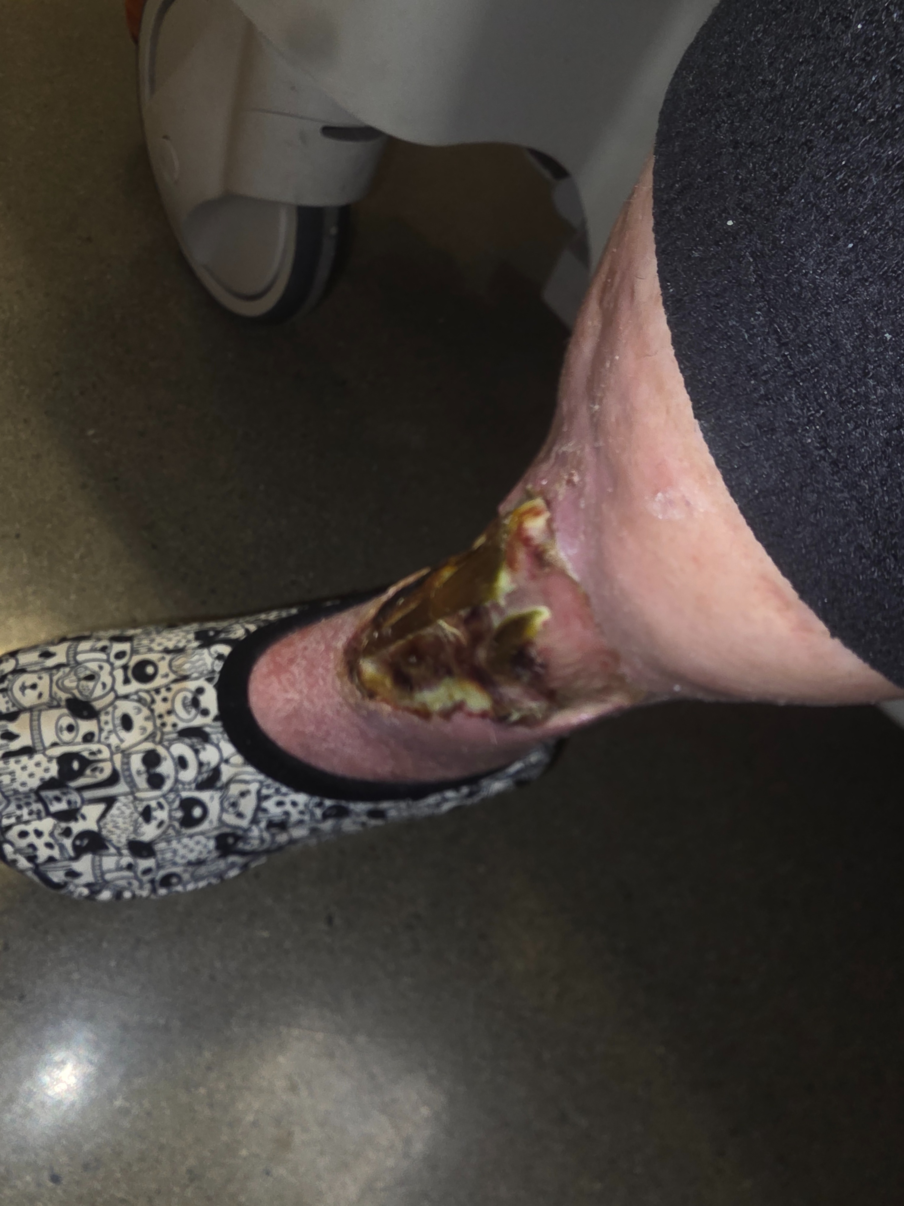 Help Save My Mom's Leg and Cover Medical Bills campaign photo, 5 of 6