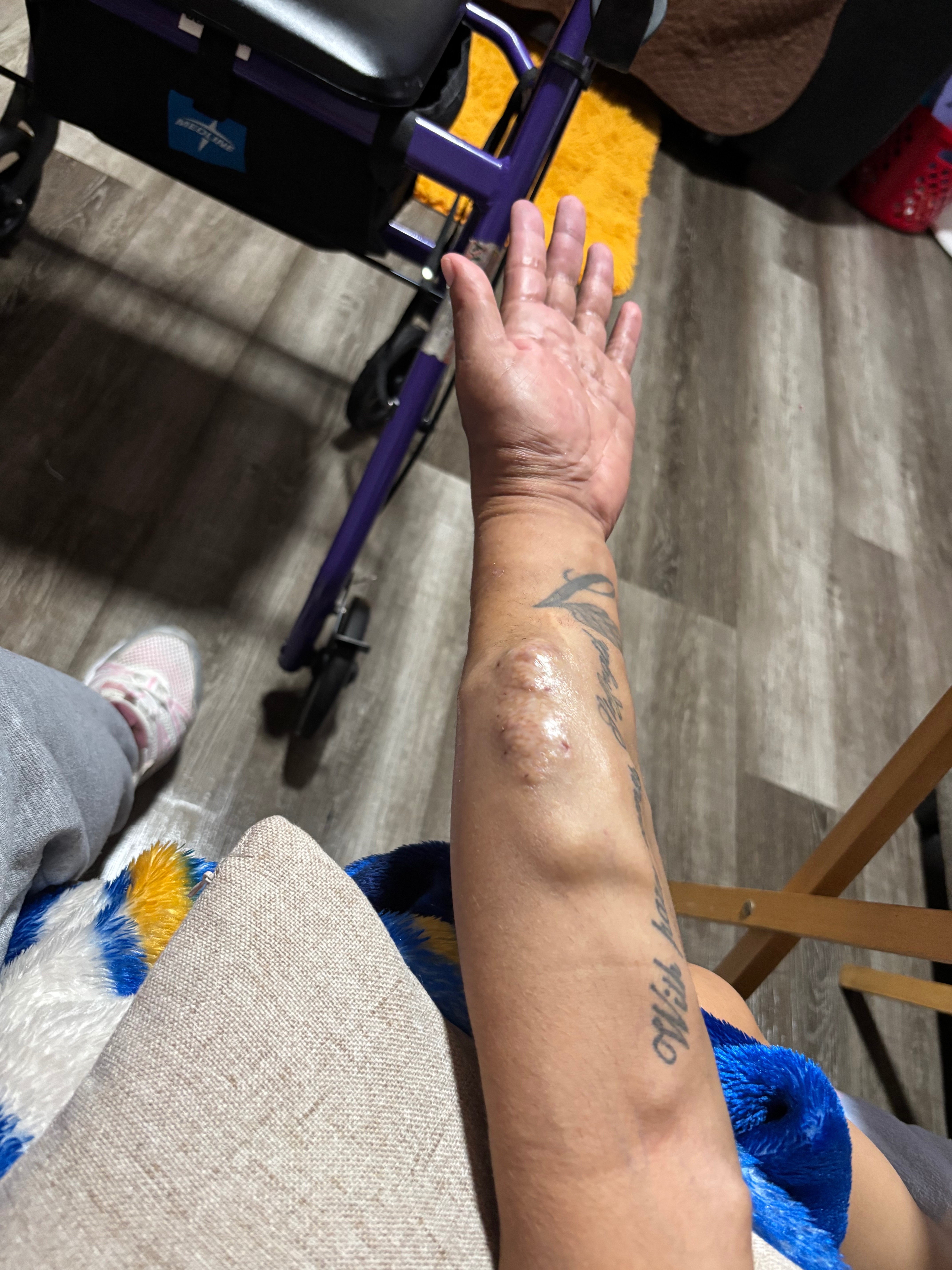 Support for Compression Gloves & Healing campaign photo, 2 of 7