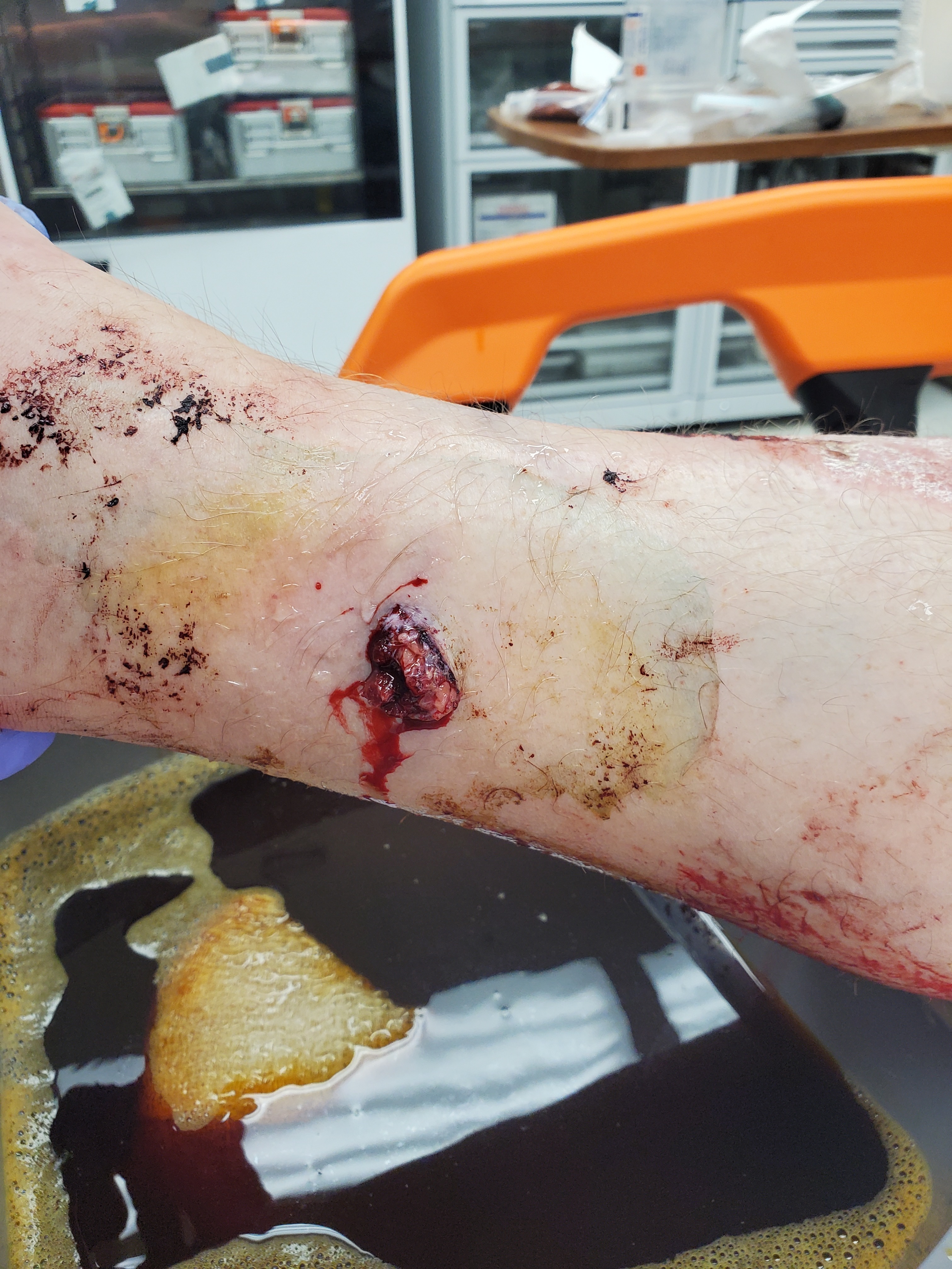 Support Chris’s Recovery After Motorcycle Accident campaign photo, 7 of 8