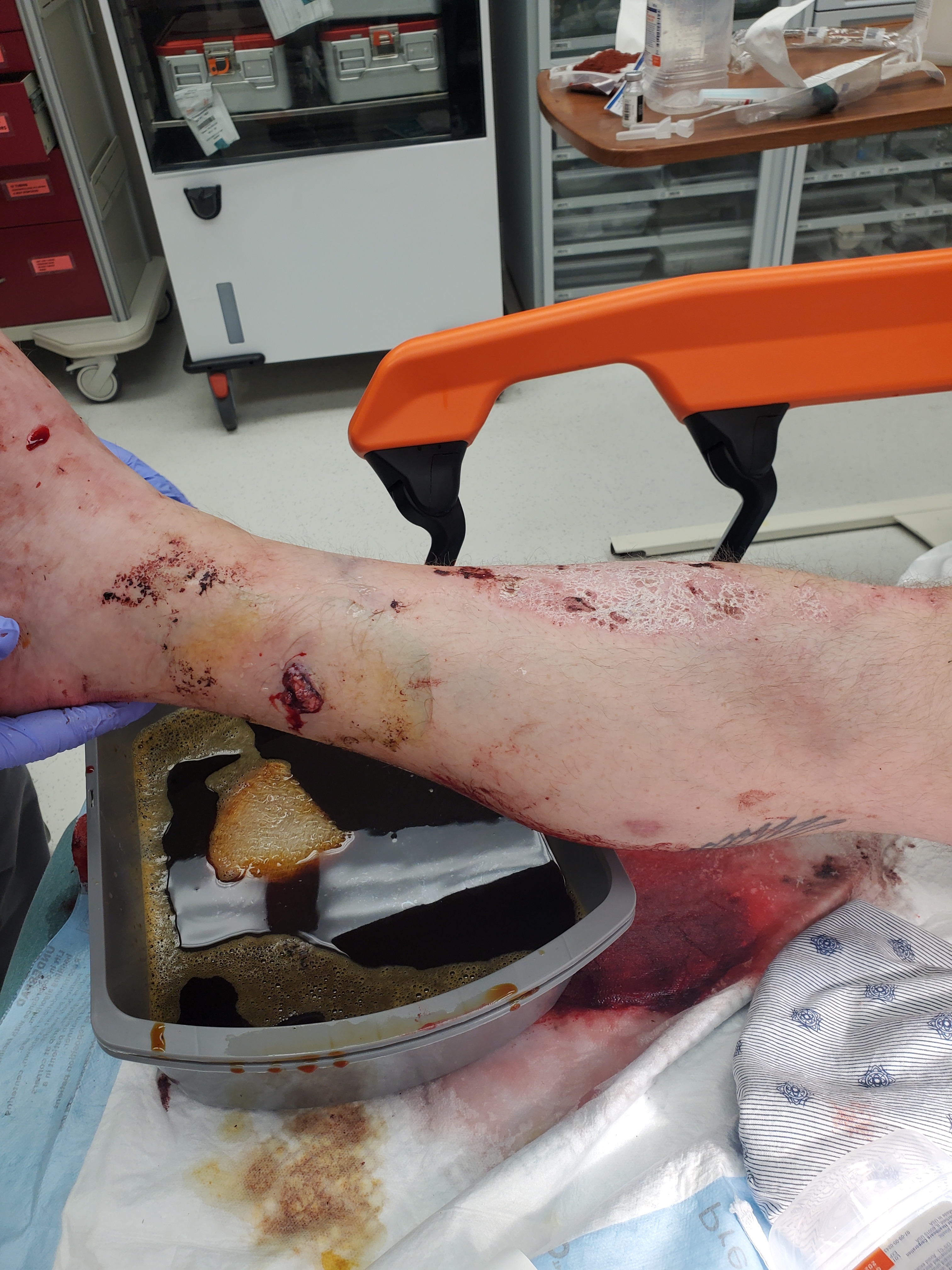 Support Chris’s Recovery After Motorcycle Accident campaign photo, 4 of 8