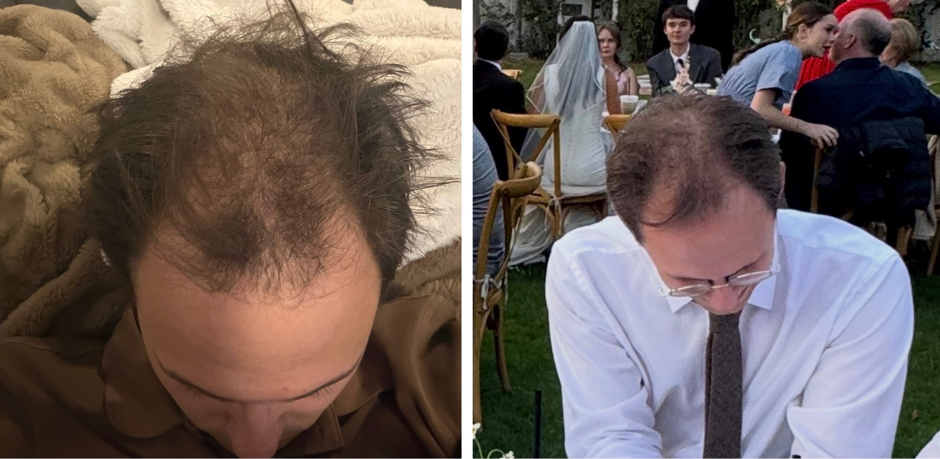 Help Harrison Get A Hair Transplant campaign photo, 2 of 5