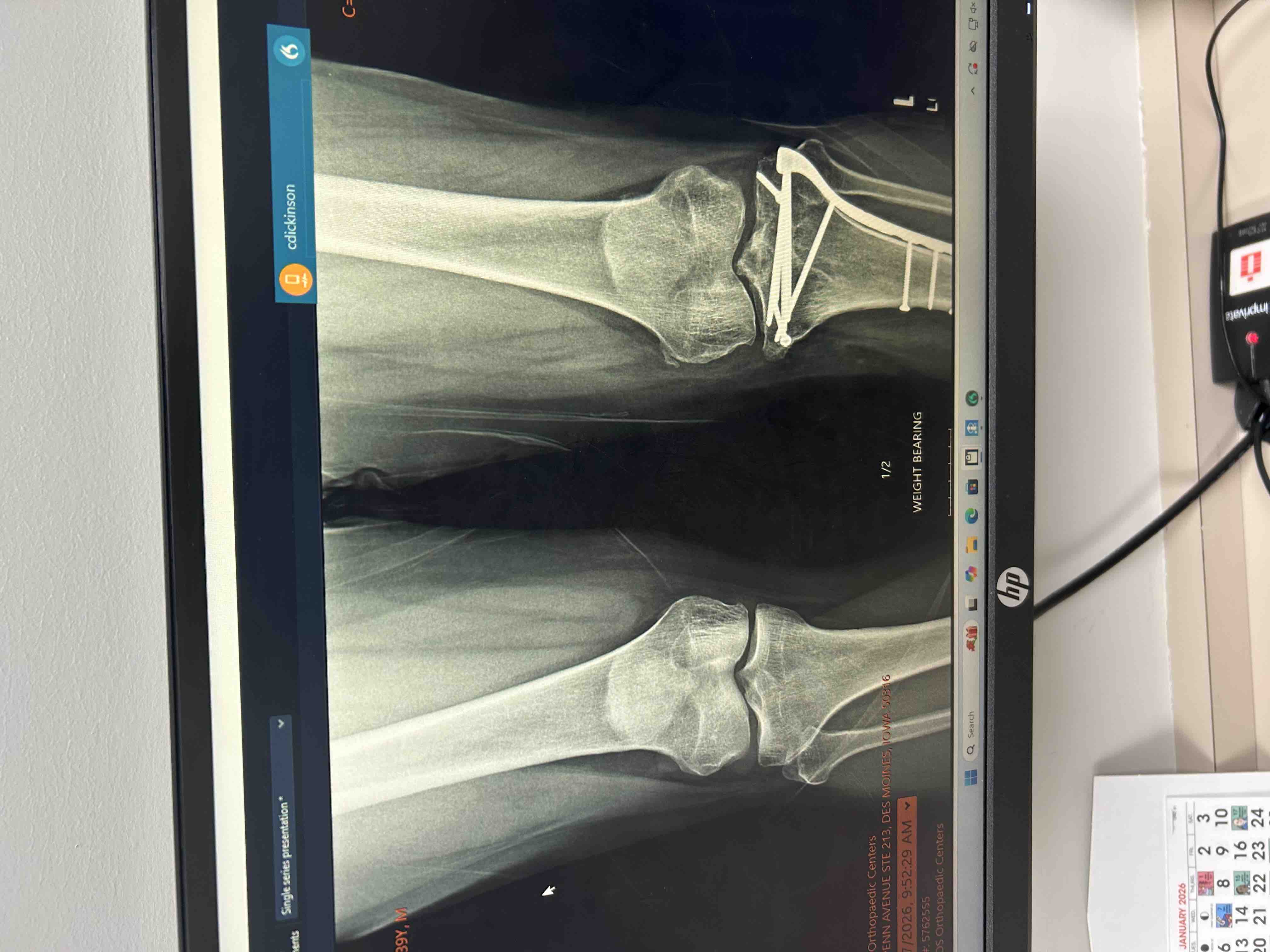  “Matt Jones’ Knee Surgery & Recovery fund age 39 campaign photo, 7 of 8