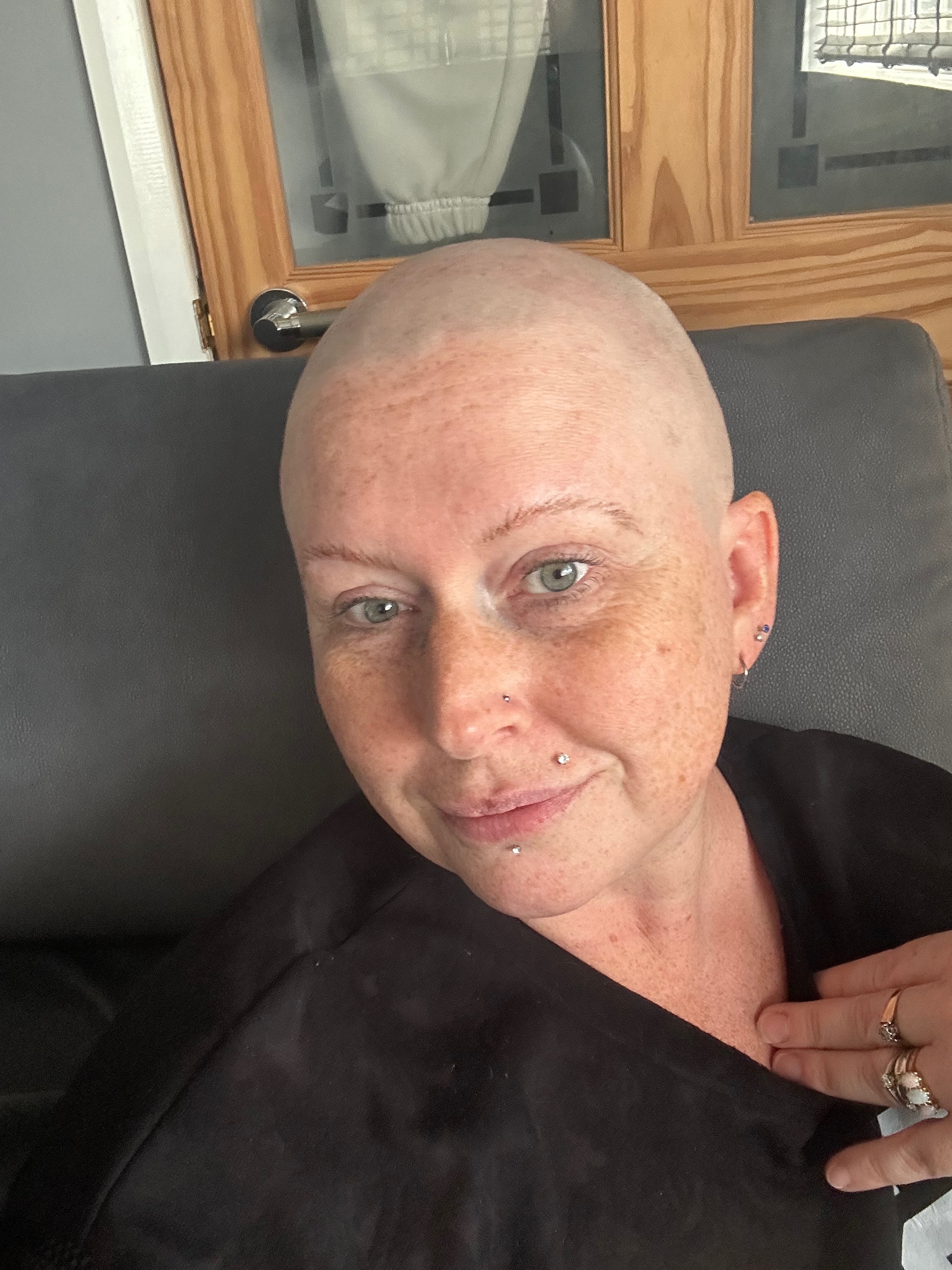 Alopecia campaign photo, 6 of 7