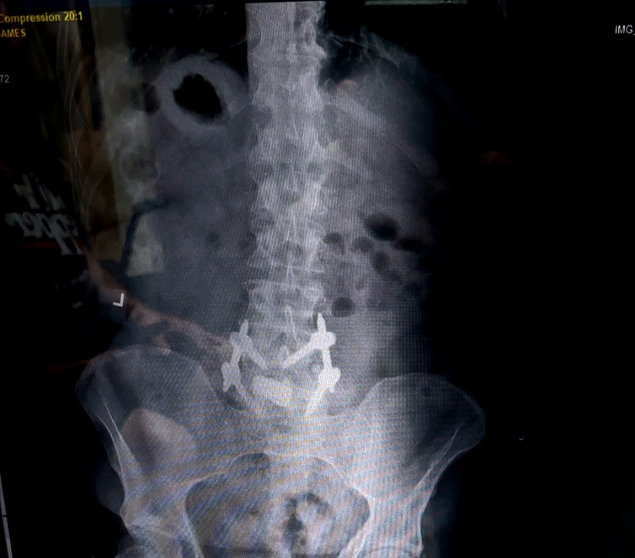Back Surgery & Recovery Support campaign photo, 4 of 7