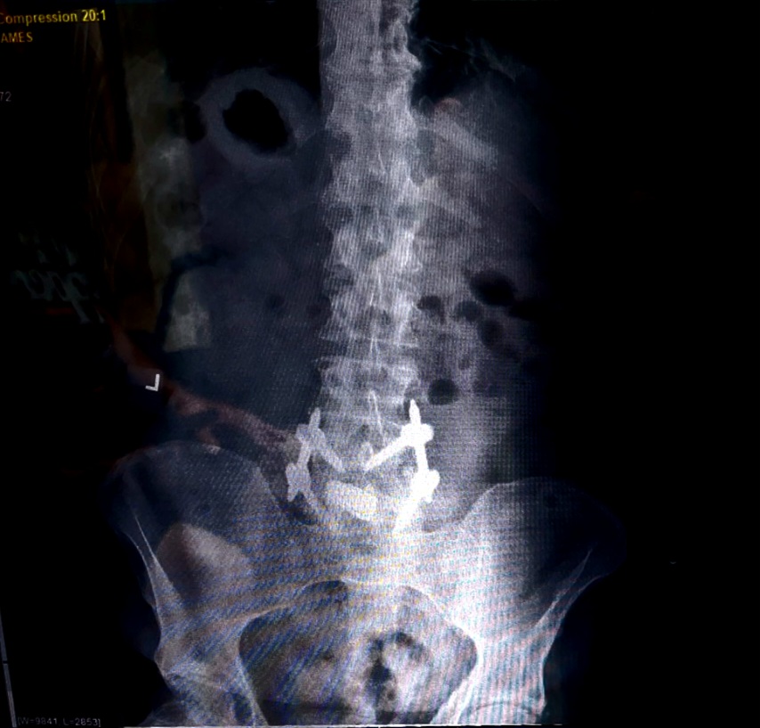 Back Surgery & Recovery Support campaign photo, 5 of 7