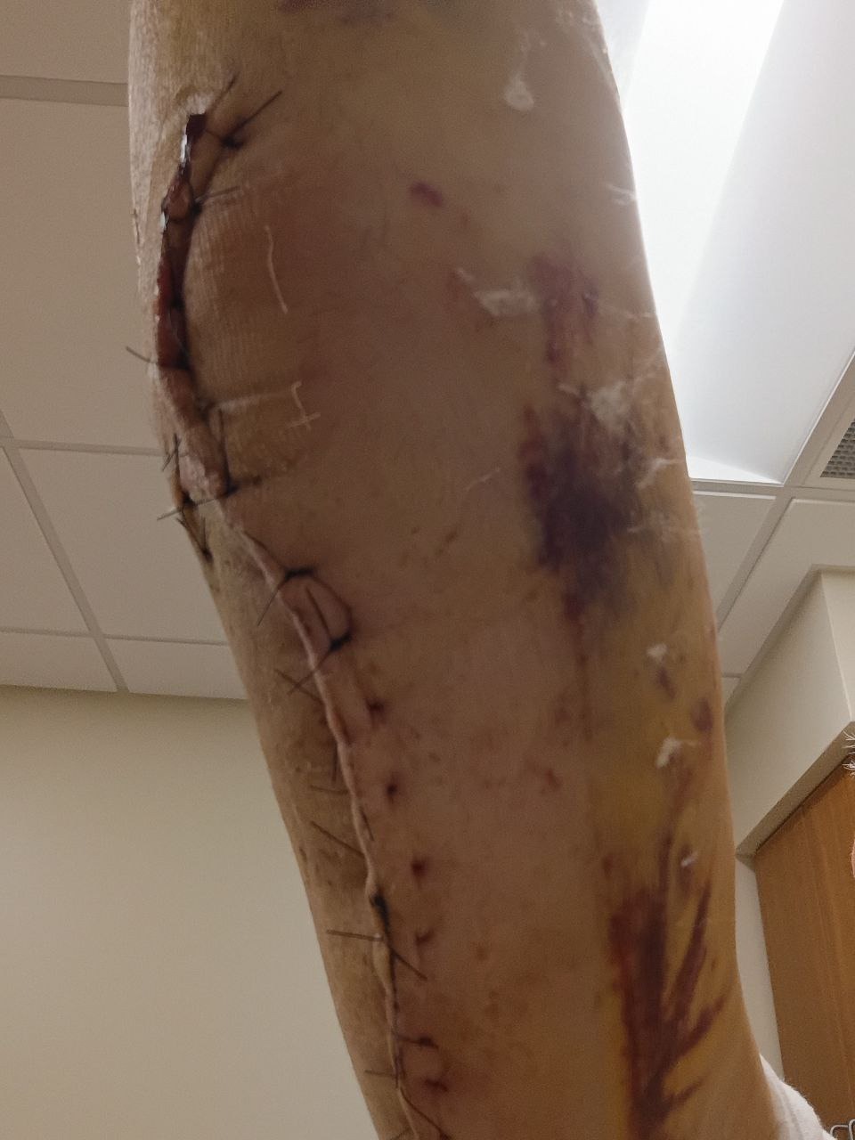 Support After Severe Arm Injury and Surgeries campaign photo, 7 of 8