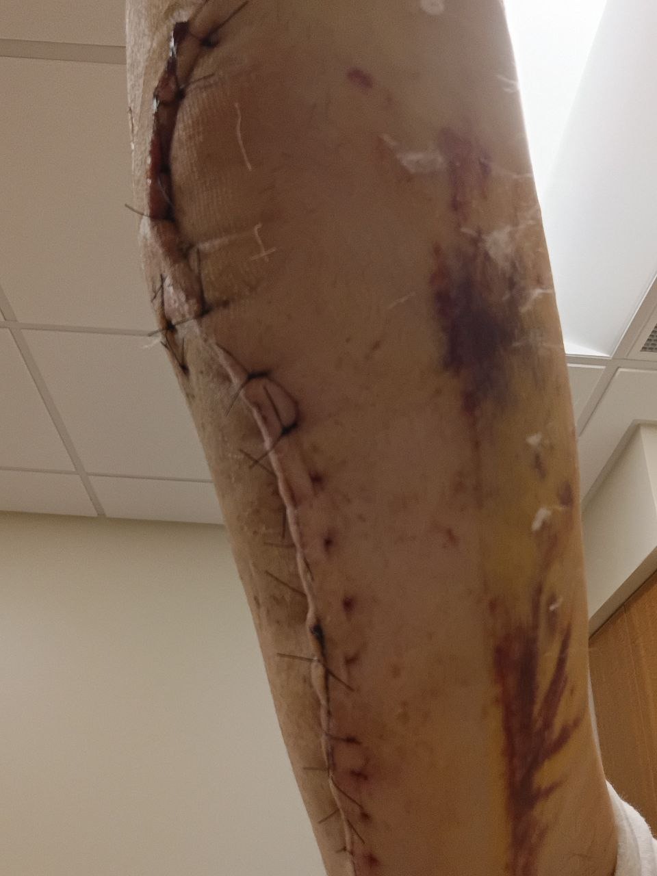 Support After Severe Arm Injury and Surgeries campaign photo, 2 of 8