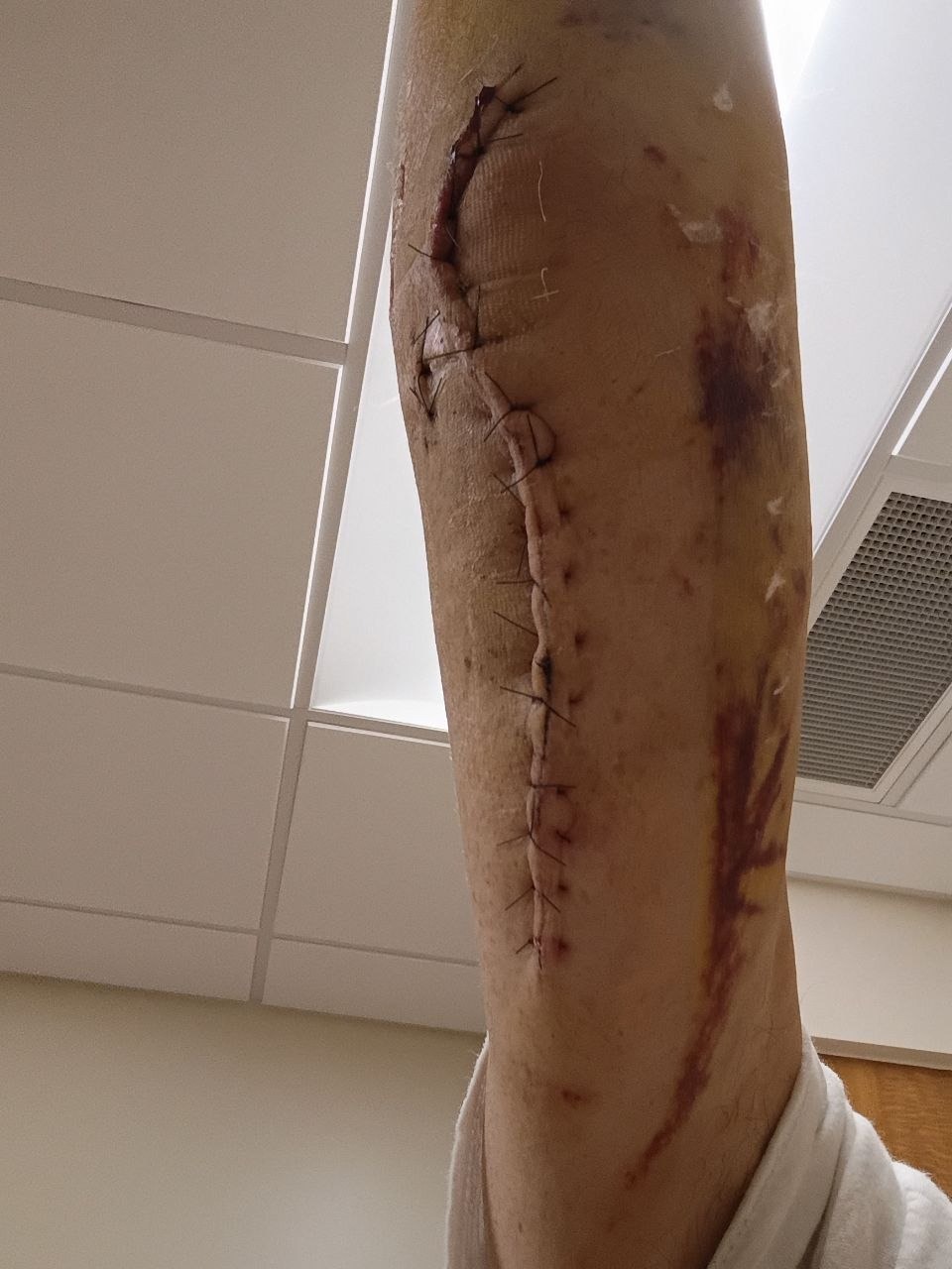 Support After Severe Arm Injury and Surgeries campaign photo, 4 of 8