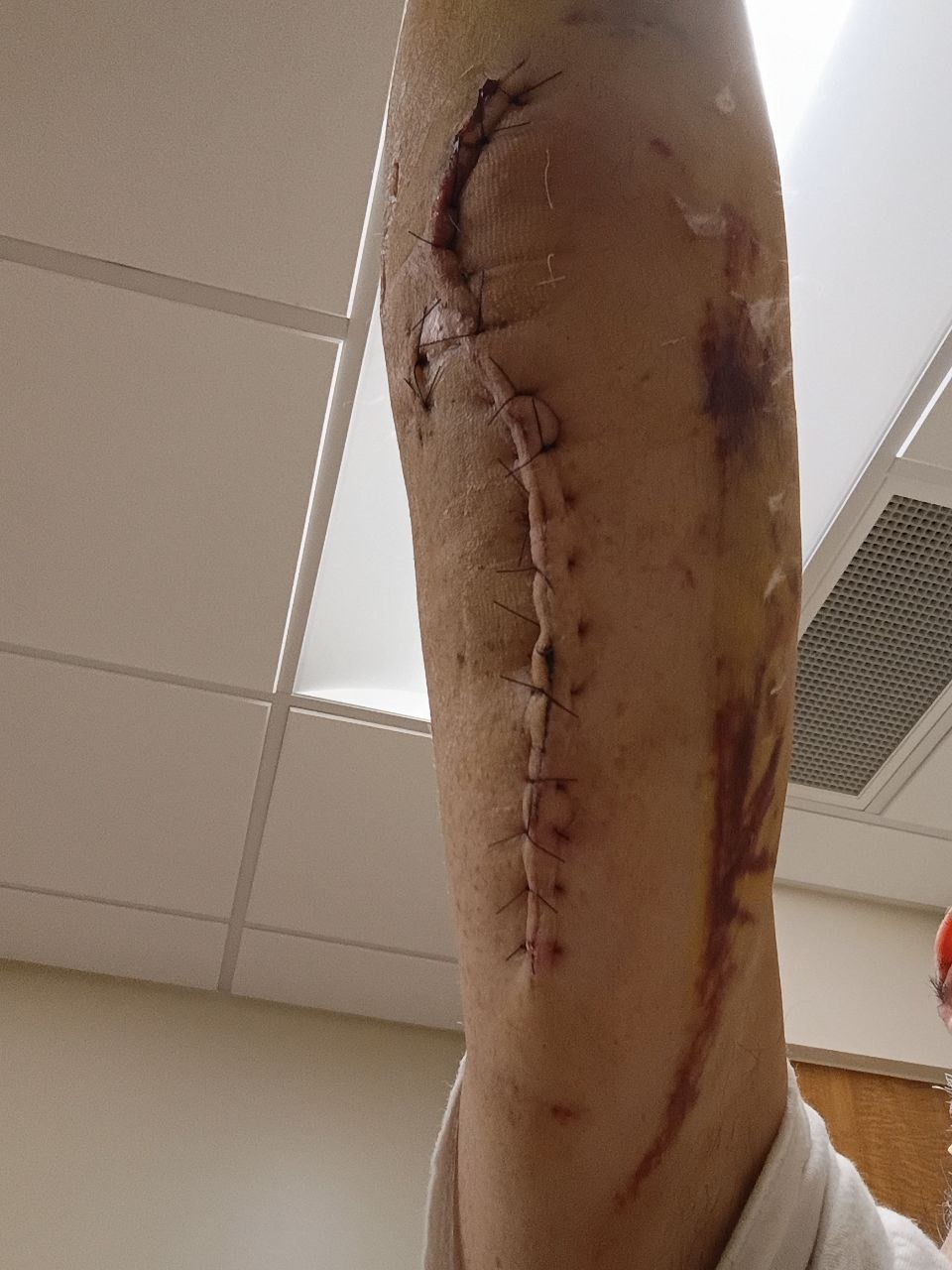 Support After Severe Arm Injury and Surgeries campaign photo, 5 of 8