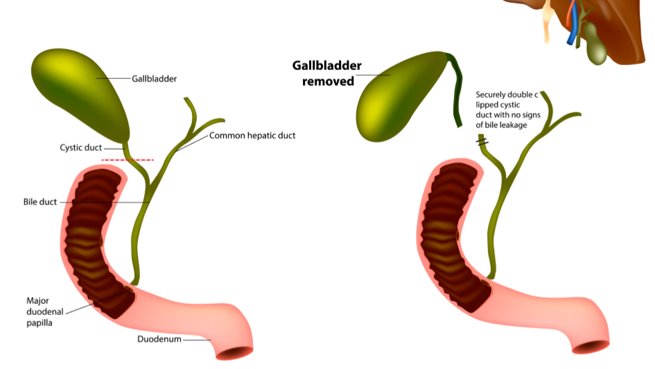 Help Cover Medical Costs After Gallbladder Surgery photo