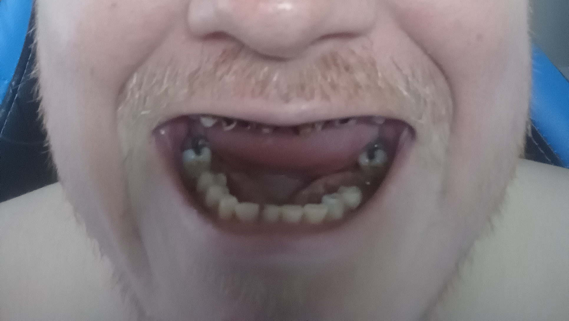 Christopher Needs Dentures, Please Help photo