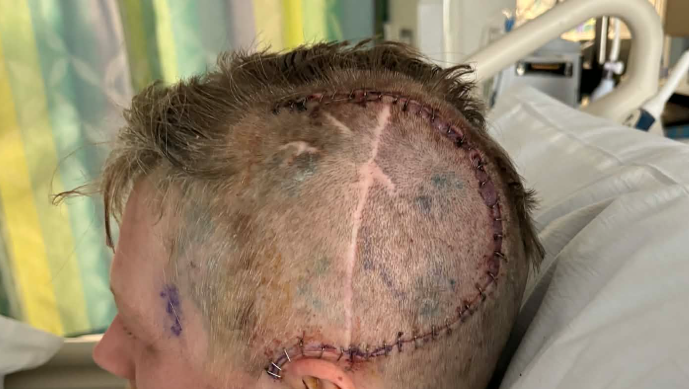 35 and Just Had Brain Surgery, I am recovering each day.  photo