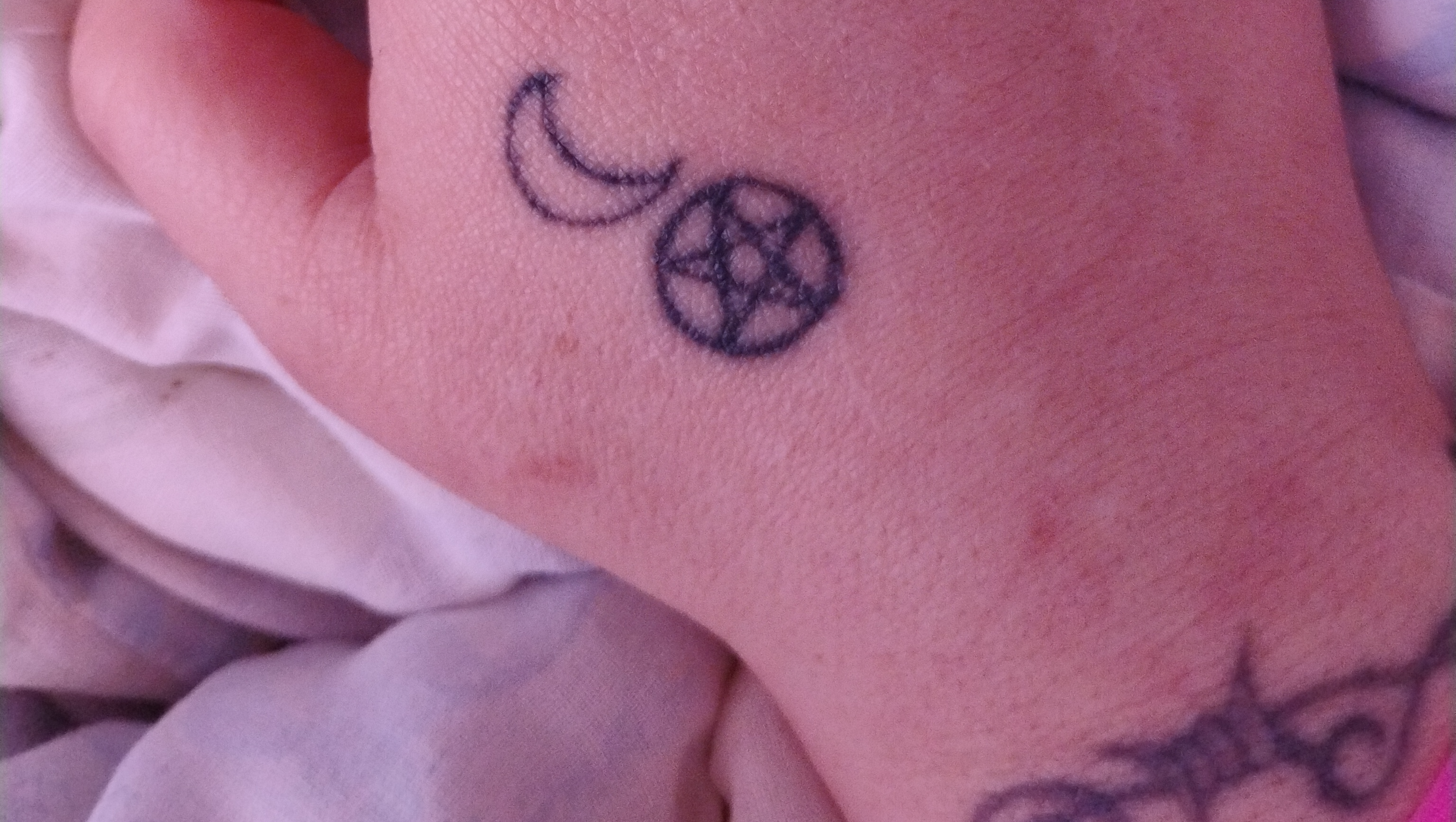 Removing a Tattoo for Inner Peace photo