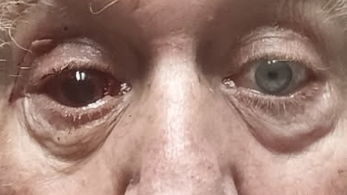 Support for Larry's (Butch) eye removal surgery - recovery photo