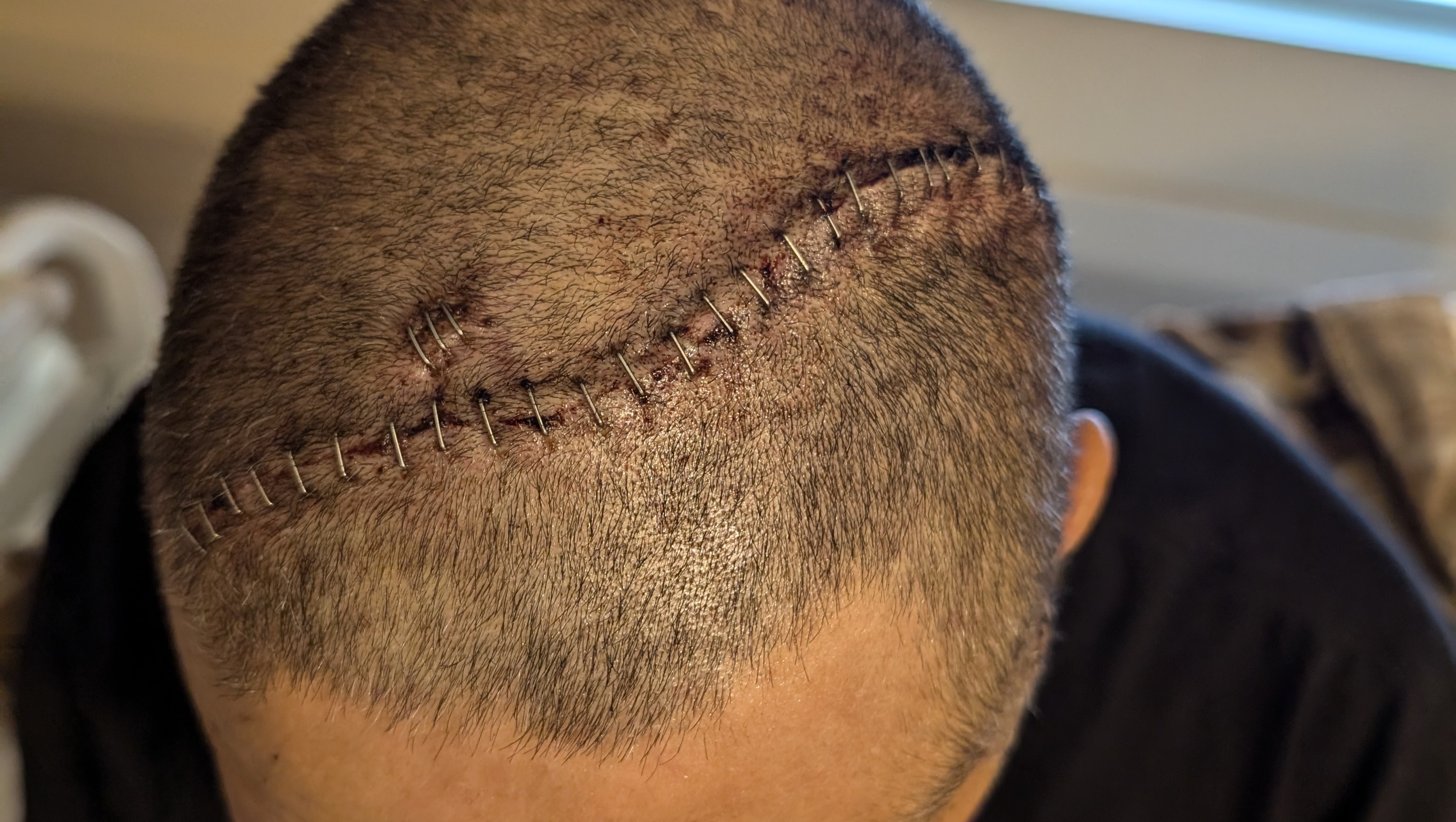 Help Anthony with unexpected medical costs from surgery! photo