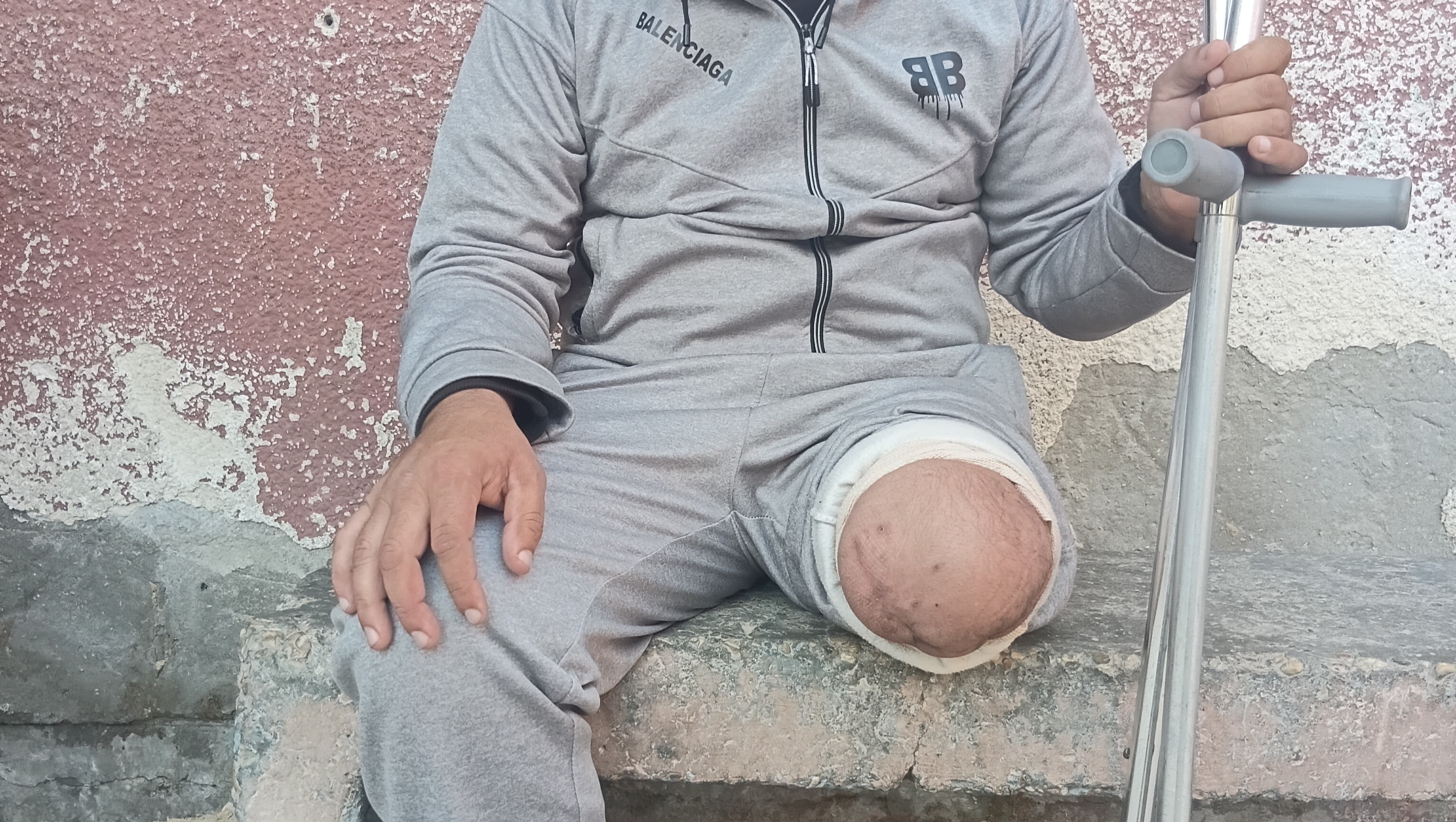 Please help me get my husband a prosthetic limb after his le photo