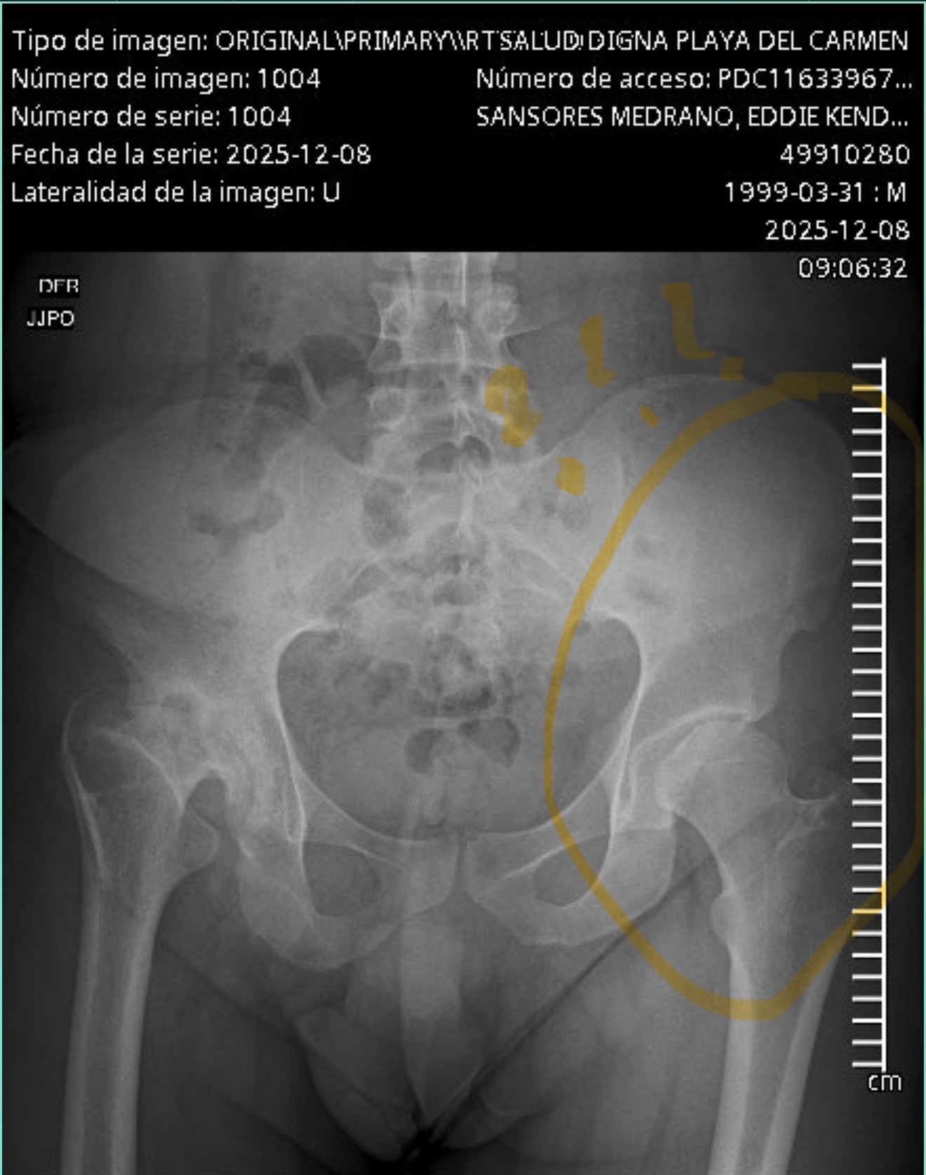 Prótesis en la cadera (Hip replacement) campaign photo, 5 of 8