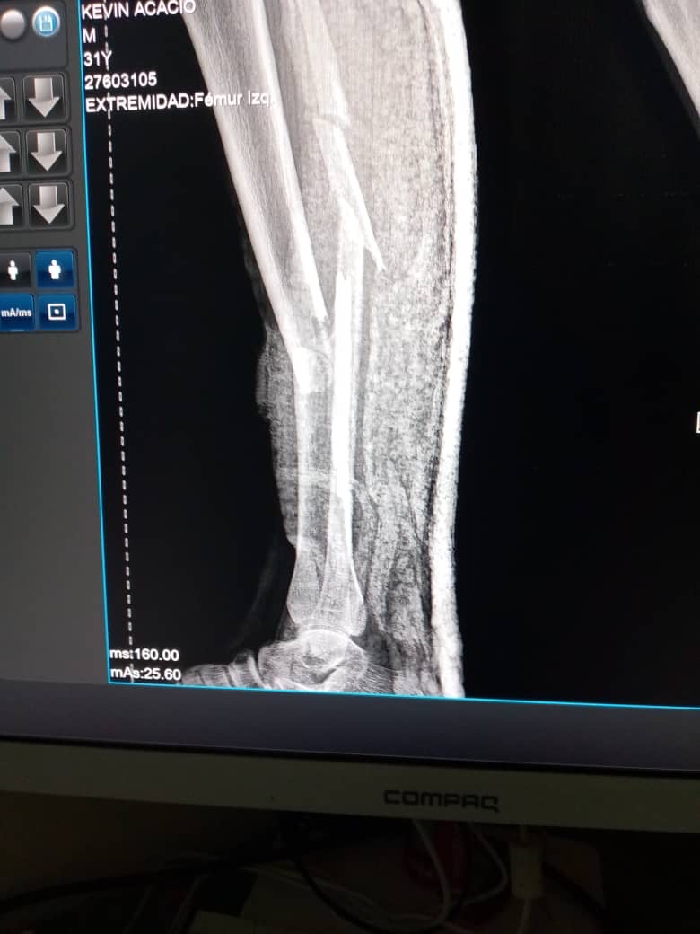 Help Kevin Acacio’s Surgery - Ayuda a Kevin campaign photo, 2 of 7
