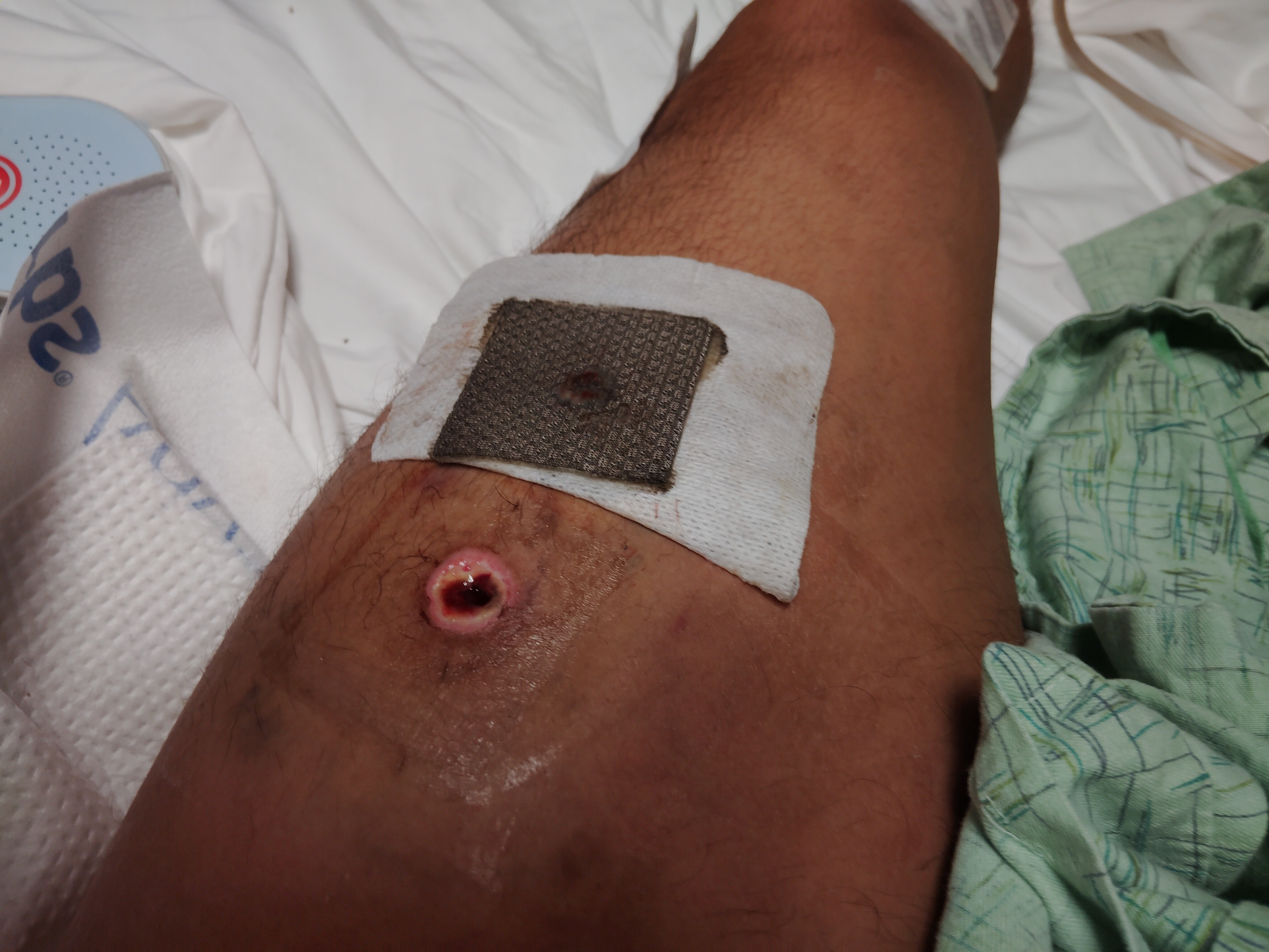 Support Angelo's Long Road to Recovery campaign photo, 5 of 7