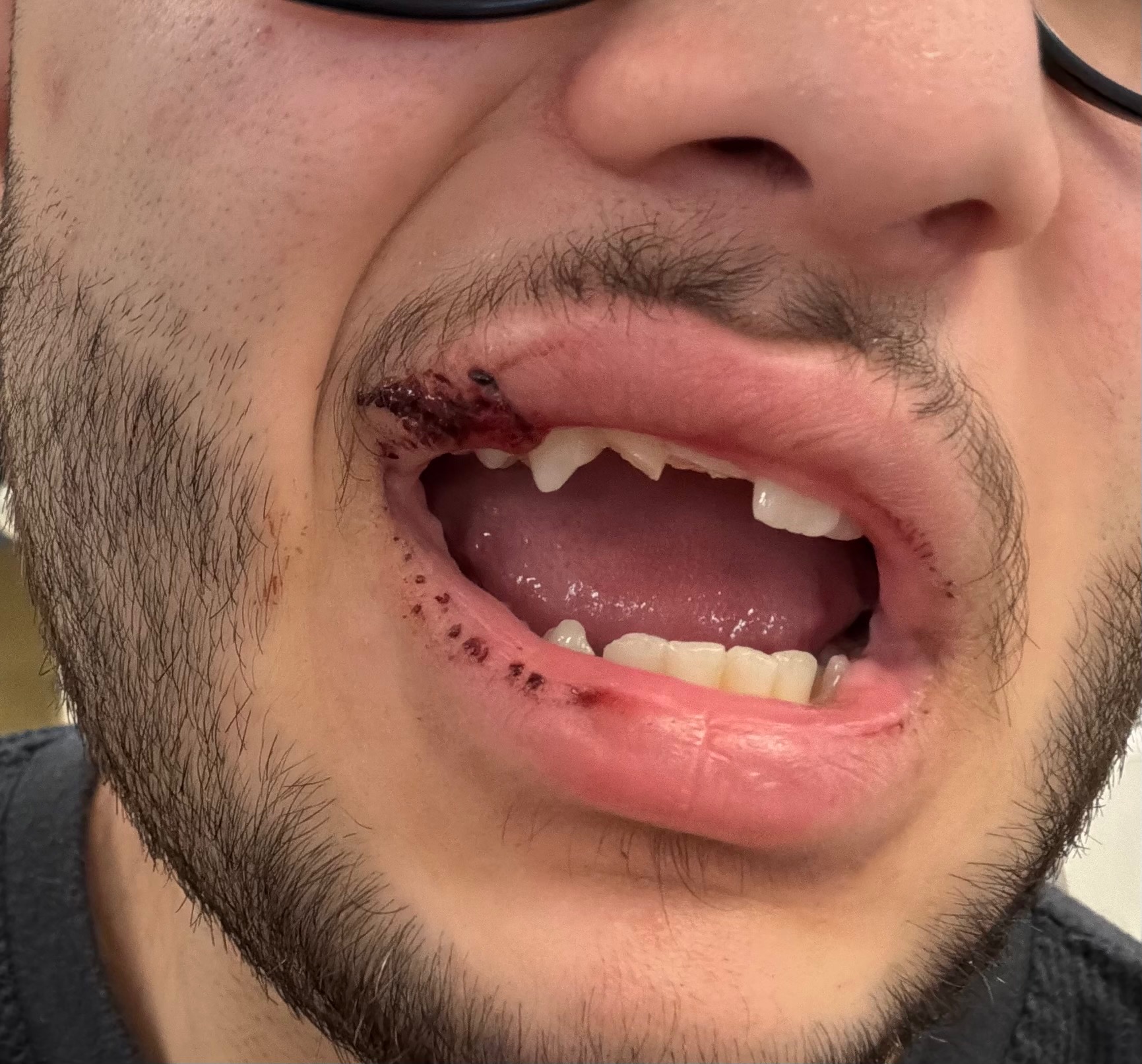 Heroic Son Injured Saving Our Dogs from a Coyote — Emergency campaign photo, 7 of 8