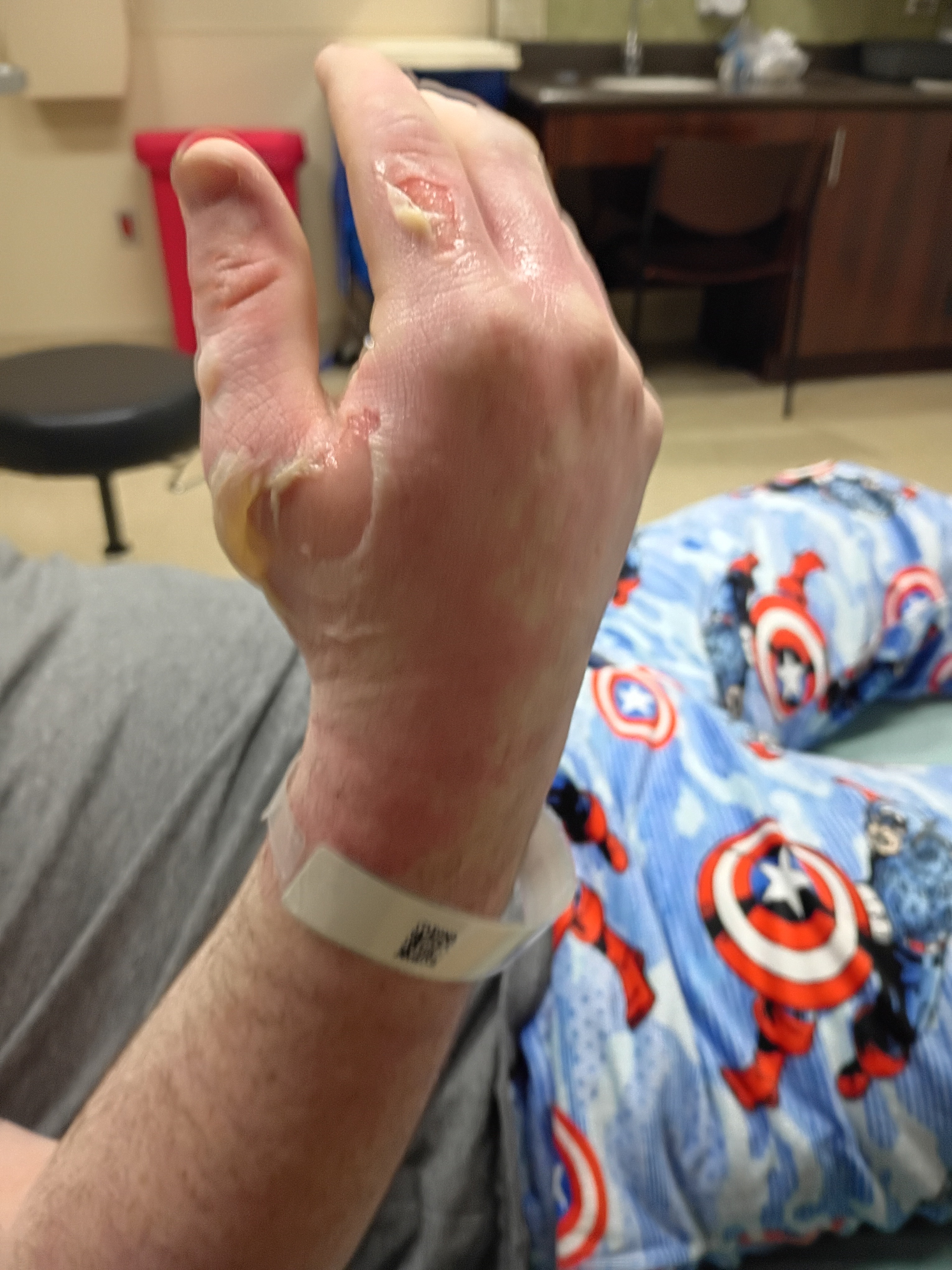 Support Ethan’s Recovery After Burn Accident campaign photo, 2 of 8