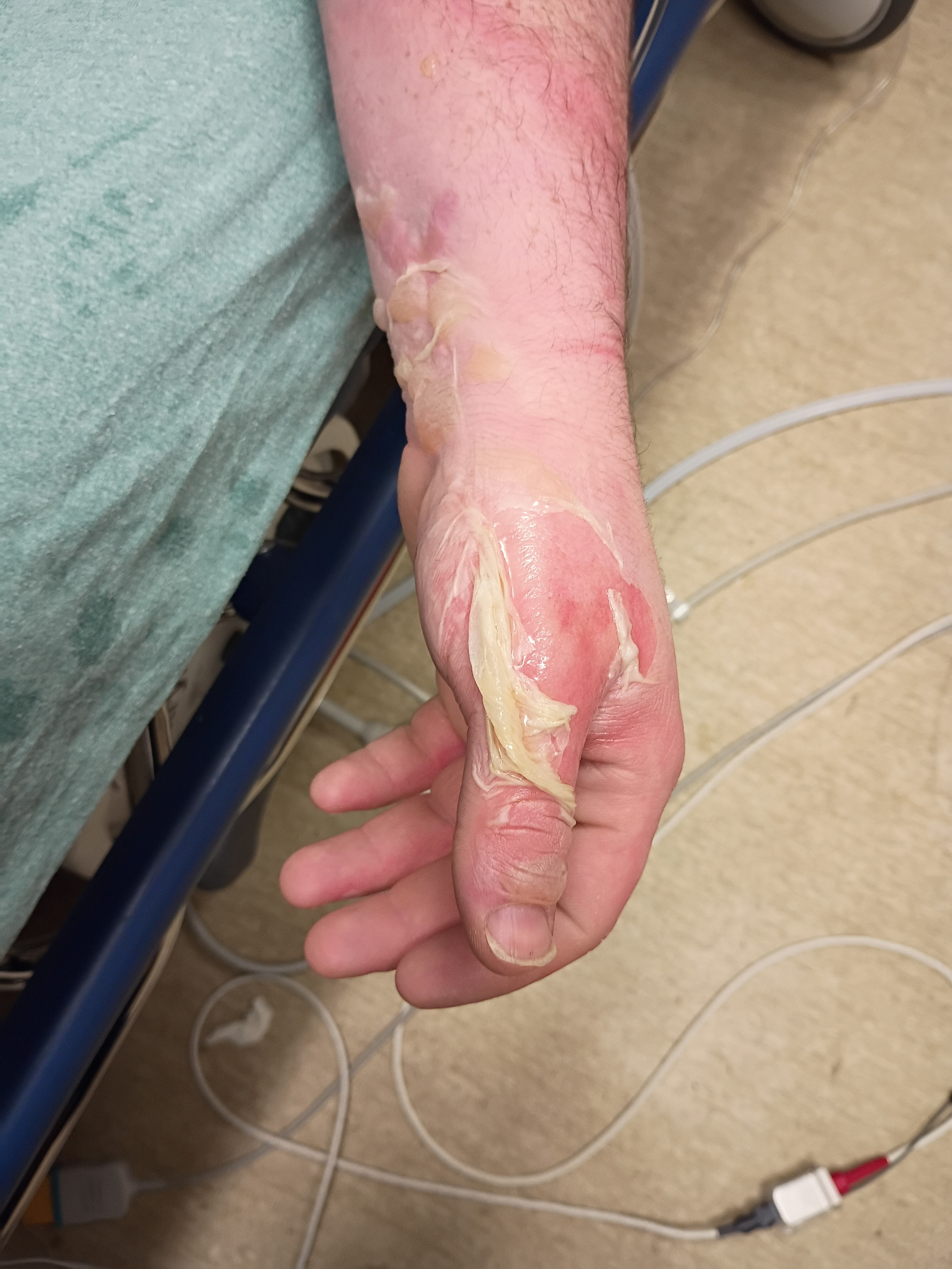 Support Ethan’s Recovery After Burn Accident campaign photo, 4 of 8