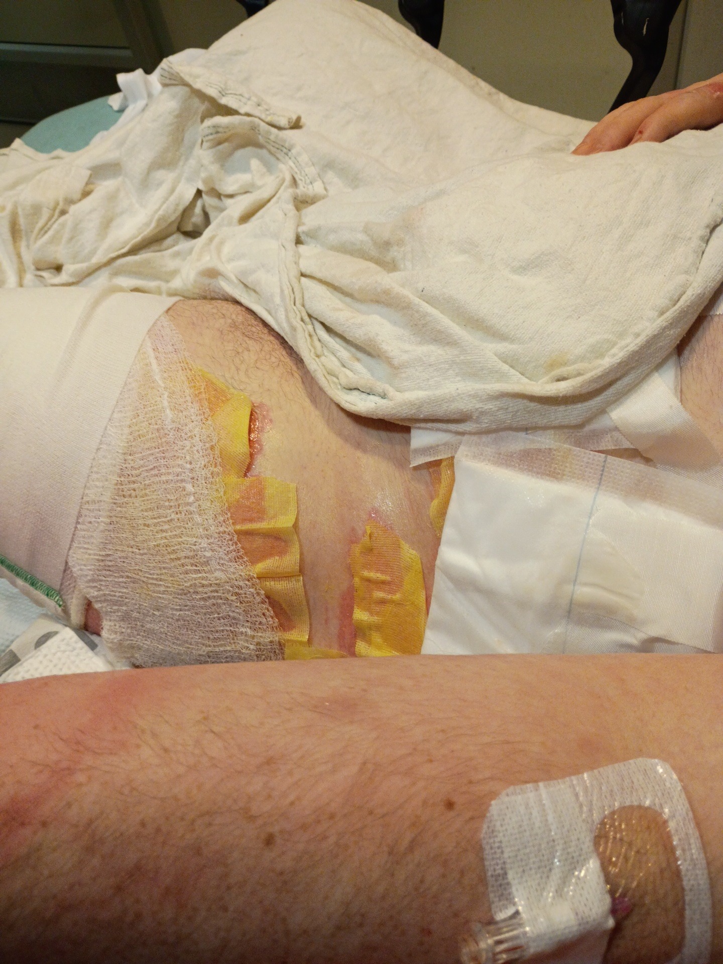 Support Ethan’s Recovery After Burn Accident campaign photo, 6 of 8