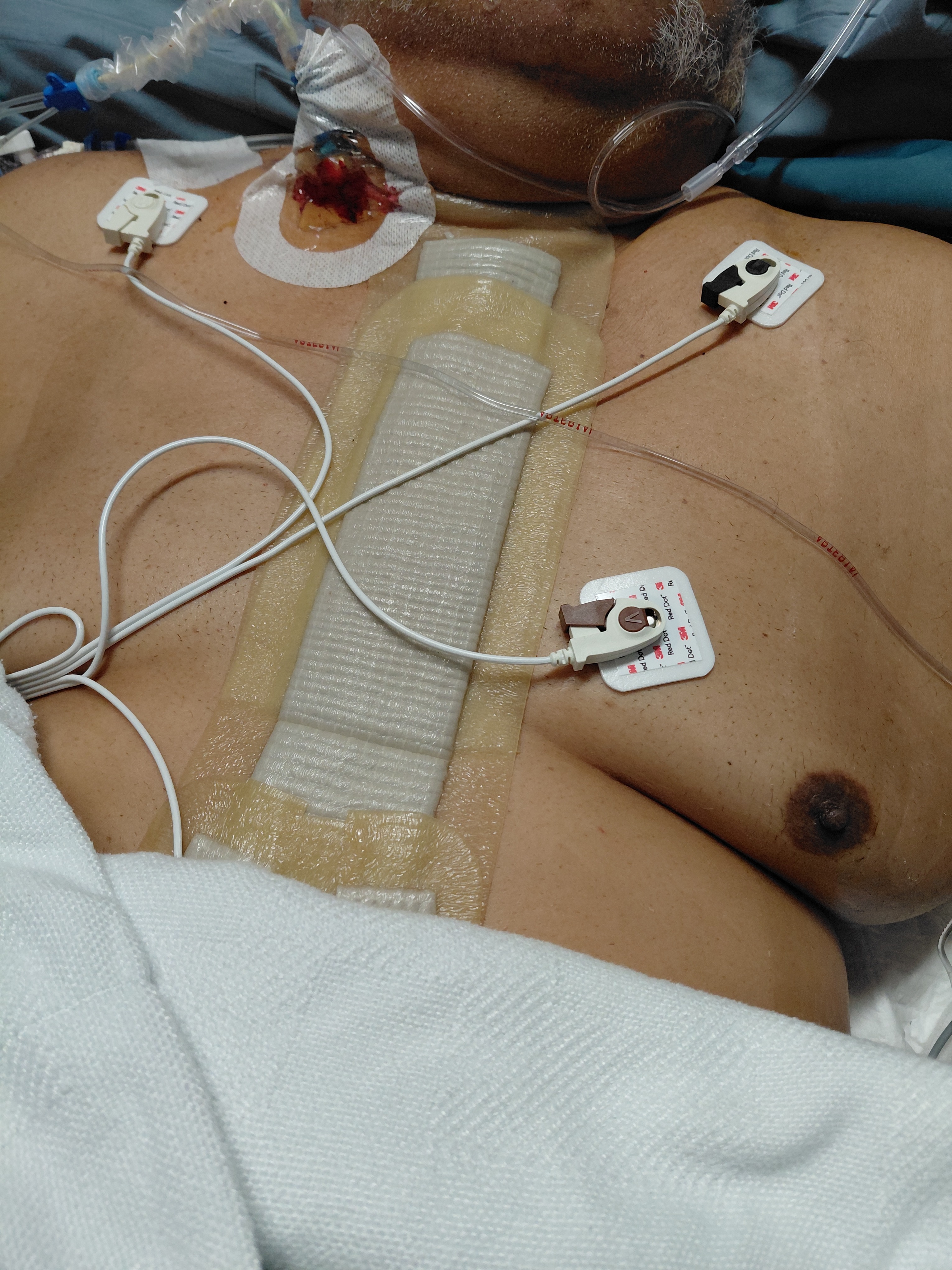 Support Raymond’s Recovery After Heart Surgery campaign photo, 5 of 6