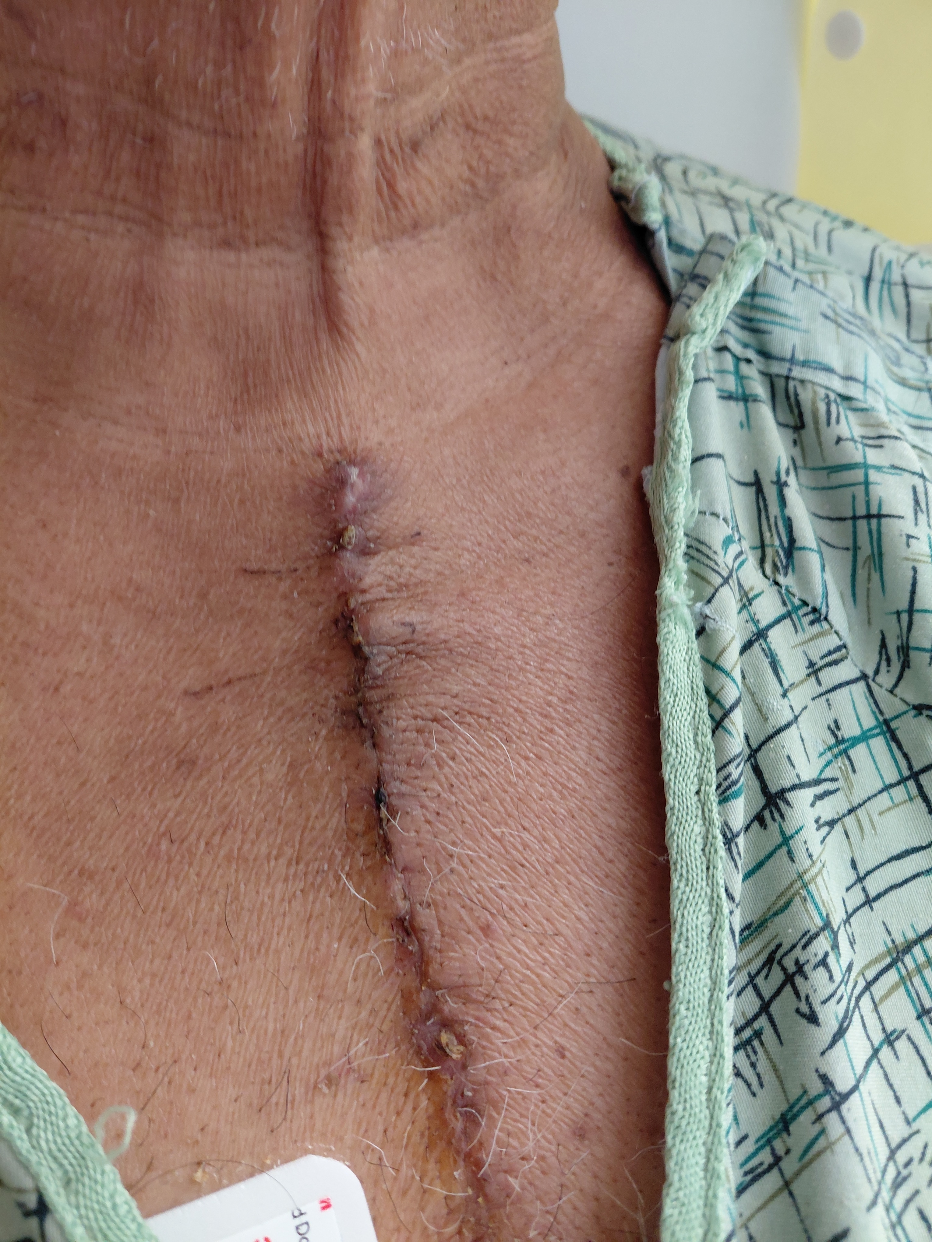 Support Raymond’s Recovery After Heart Surgery campaign photo, 2 of 6